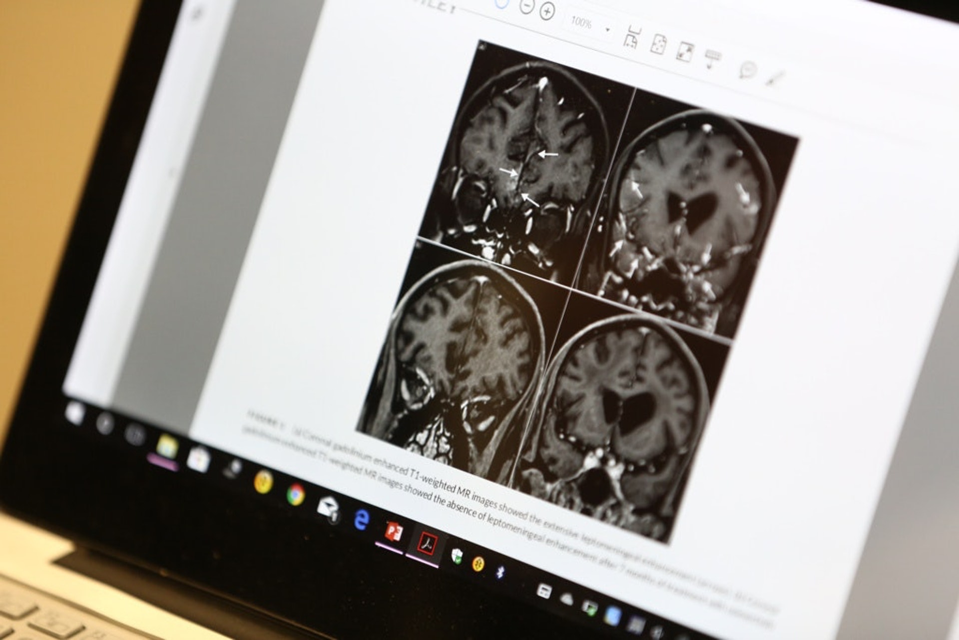 肺癌若轉移至腎上腺、肝、骨甚或腦部,幾乎無藥可治。(資料圖片) 肺癌若轉移至腎上腺、肝、骨甚或腦部,幾乎無藥可治。(資料圖片)
