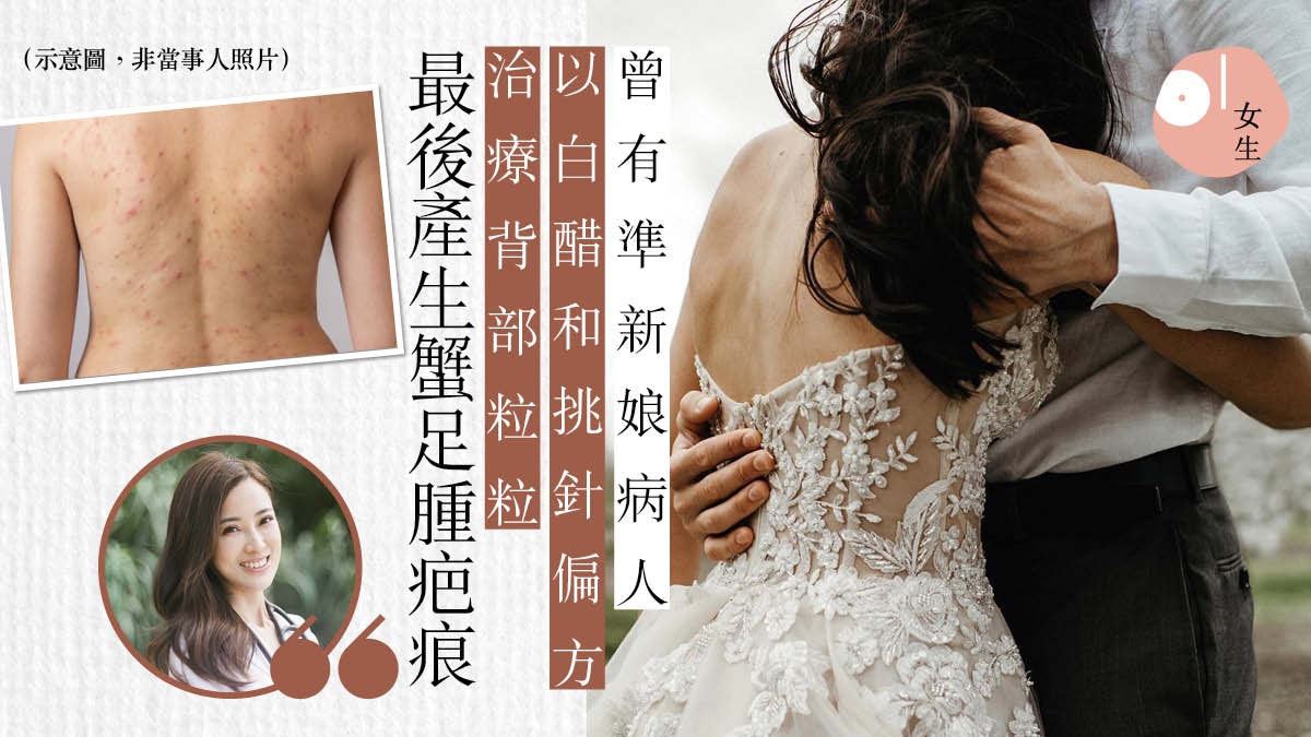 心口、背部暗粒極擾人 醫生解答:不一定是暗瘡 胡亂擠壓易留疤 心口、背部暗粒極擾人 醫生解答:不一定是暗瘡 胡亂擠壓易留疤