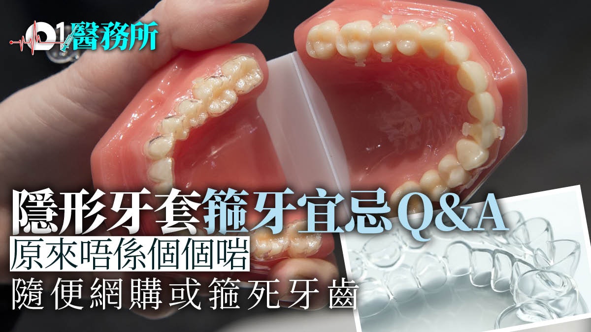 隱形牙套矯齒一文看清哪些人適合?網購自助式牙套或箍死牙齒 隱形牙套矯齒一文看清哪些人適合?網購自助式牙套或箍死牙齒