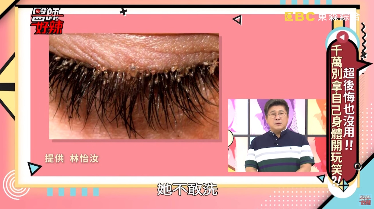 林醫生指該女病人睫毛根部出現結痂、角質及眼皮的分泌物，以及眼瞼躲藏了一隻蟎蟲。（東森電視節目《醫師好辣》截圖）