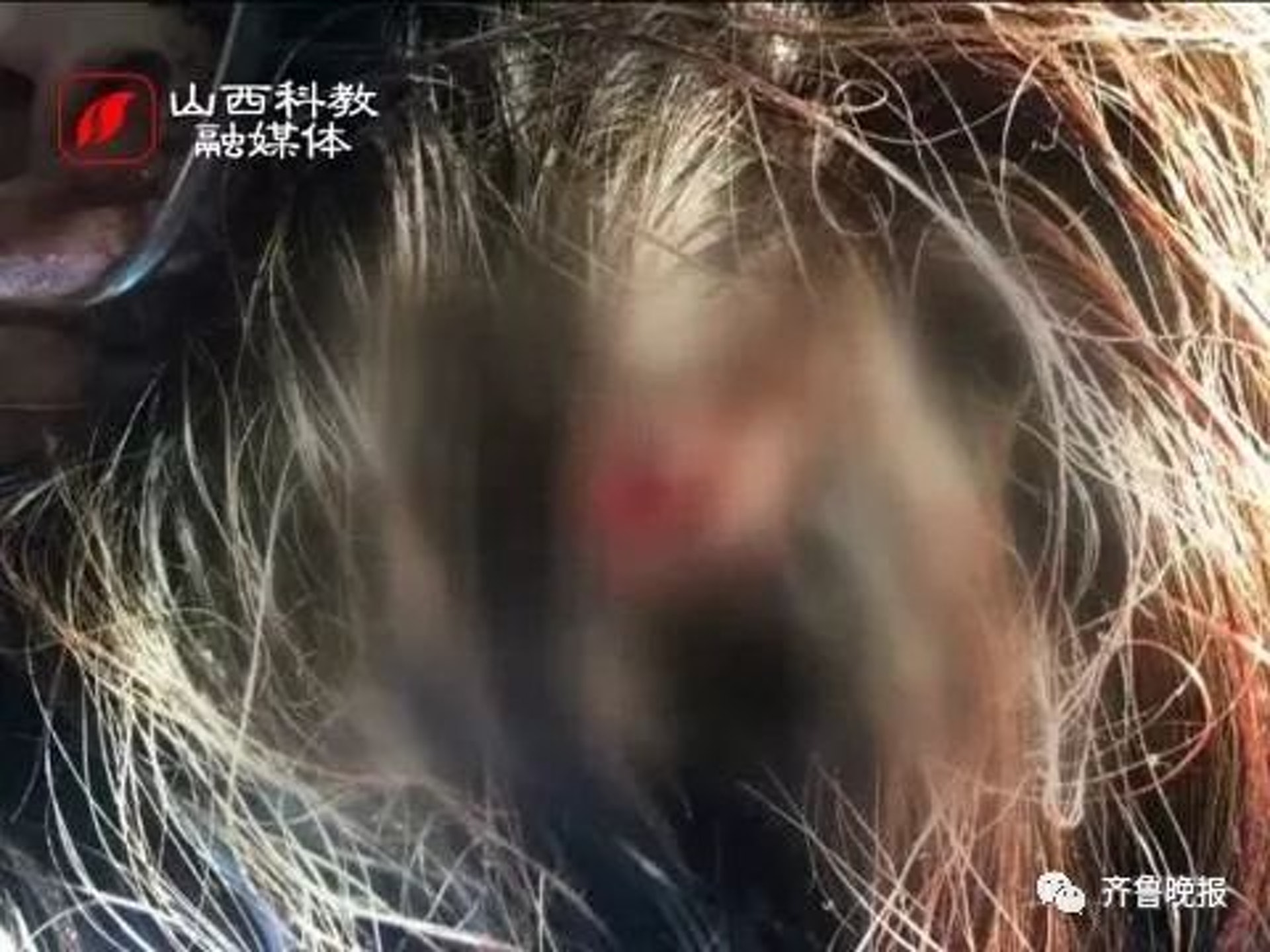 麗麗左頂頭皮裂傷,左額顳頂頭皮下血腫,還因為事件出現中度抑鬱症狀。(網上圖片) 麗麗左頂頭皮裂傷,左額顳頂頭皮下血腫,還因為事件出現中度抑鬱症狀。(網上圖片)