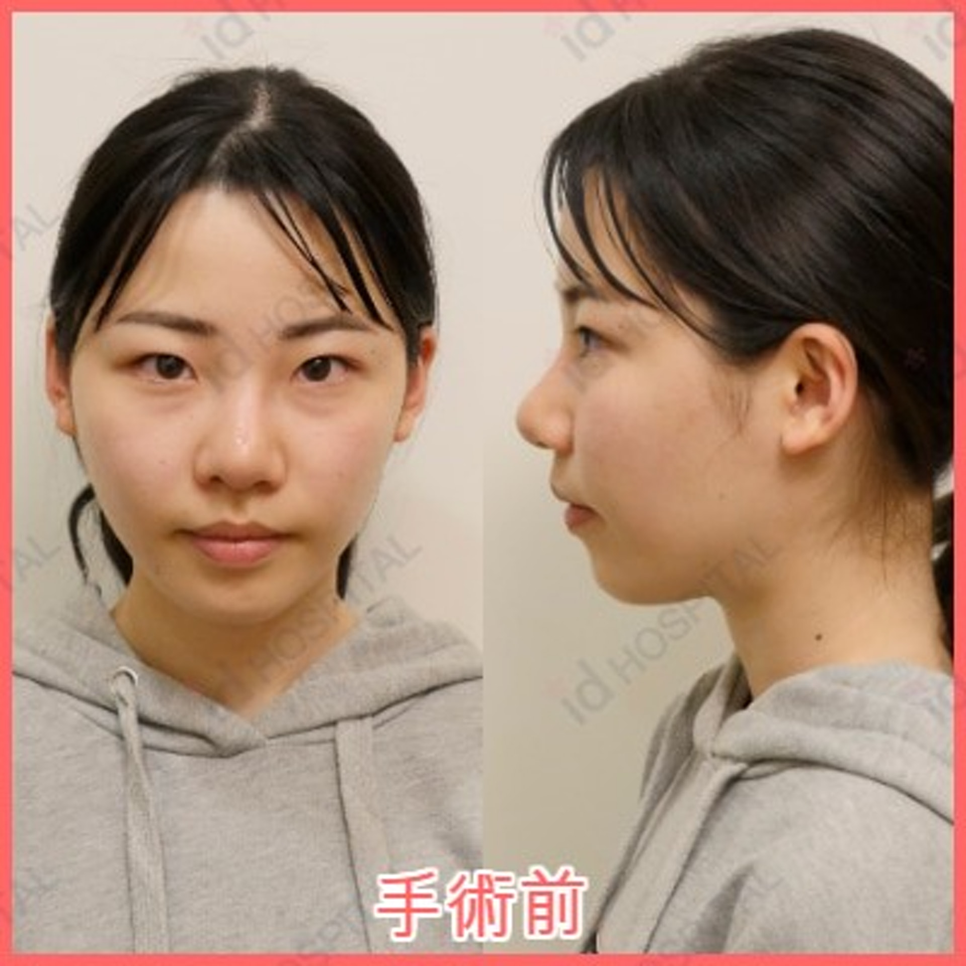 日本av女優深田詠美走紅韓媒爆整容前照片網民驚嘆手術超成功 香港01 開罐 日本av女優深田詠美走紅韓媒爆整容前照片網民驚嘆手術超成功 香港01 開罐