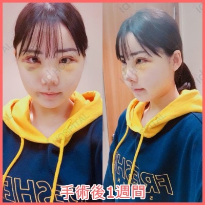 日本av女優深田詠美走紅韓媒爆整容前照片網民驚嘆手術超成功 香港01 開罐