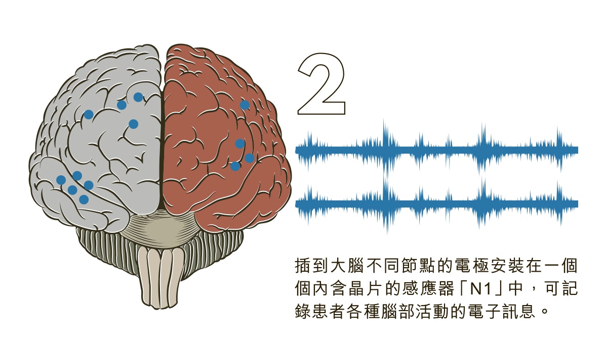 Neuralink讀取腦部活動