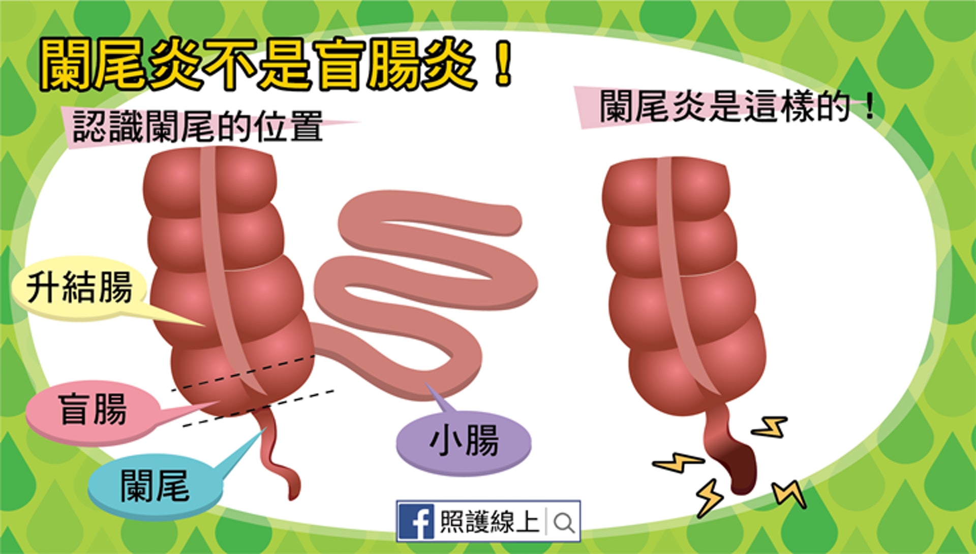 闌尾炎不等於盲腸炎（照護線上授權使用）