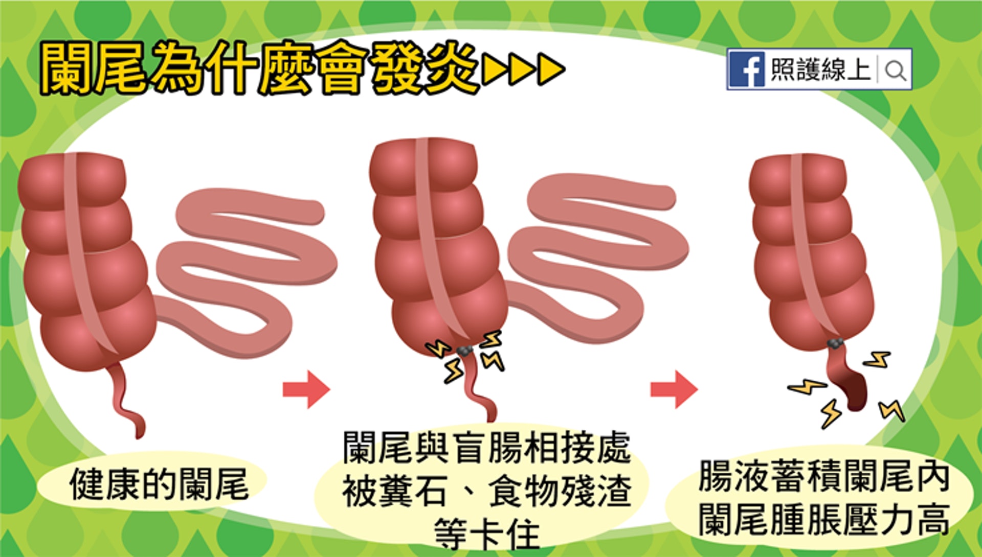 那好端端的闌尾幹嘛發炎呢？（照護線上授權使用）