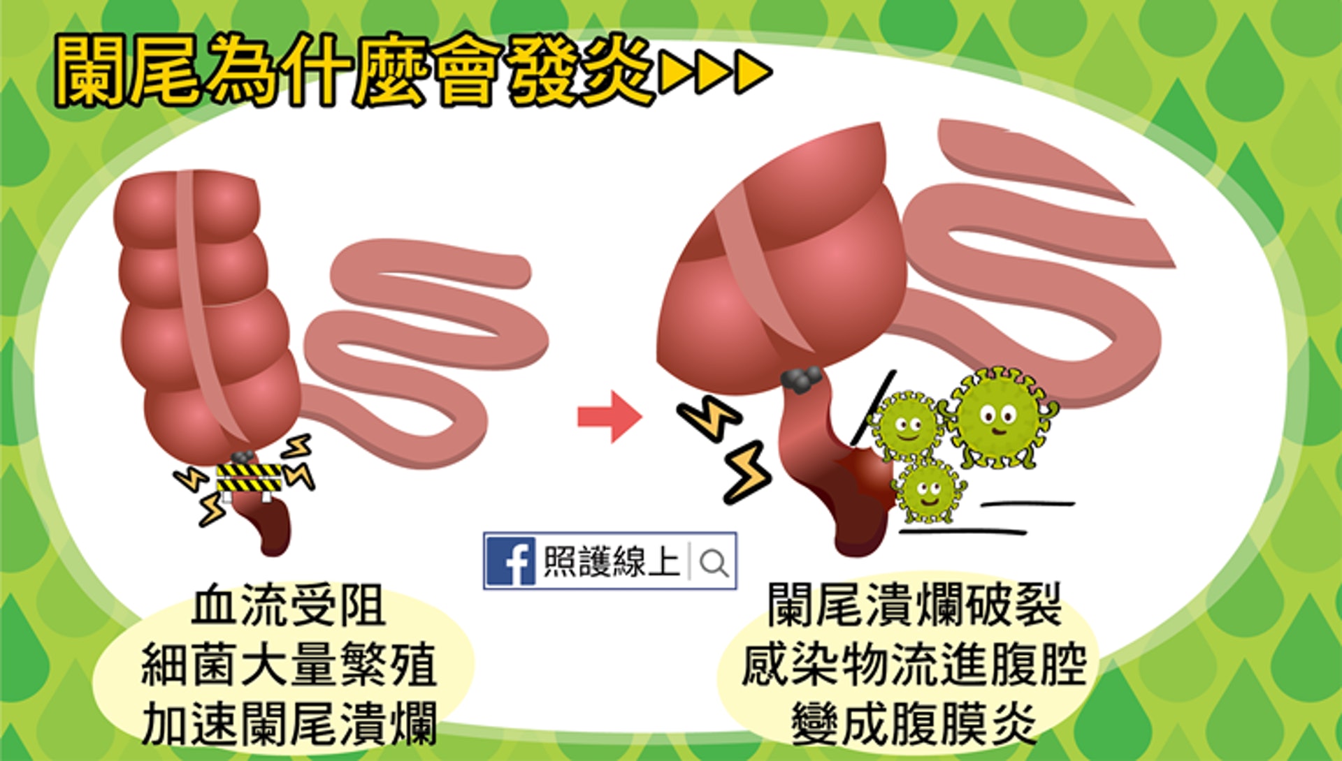 那好端端的闌尾幹嘛發炎呢?(照護線上授權使用) 那好端端的闌尾幹嘛發炎呢?(照護線上授權使用)