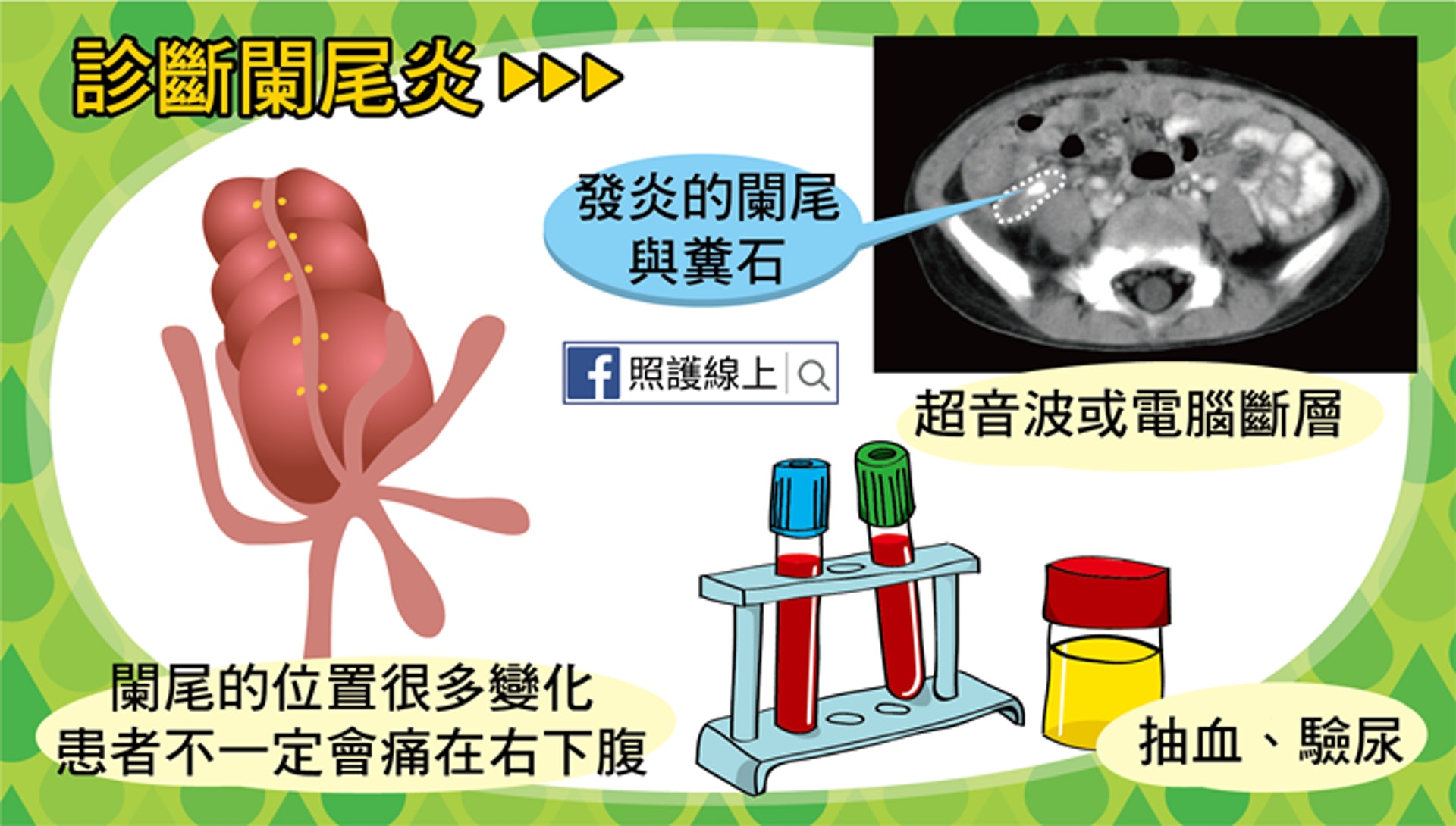 要診斷闌尾炎時,除了詳細的問診與身體理學檢查之外,還是可以考慮加上影像學檢查佐證的。(照護線上授權使用) 要診斷闌尾炎時,除了詳細的問診與身體理學檢查之外,還是可以考慮加上影像學檢查佐證的。(照護線上授權使用)