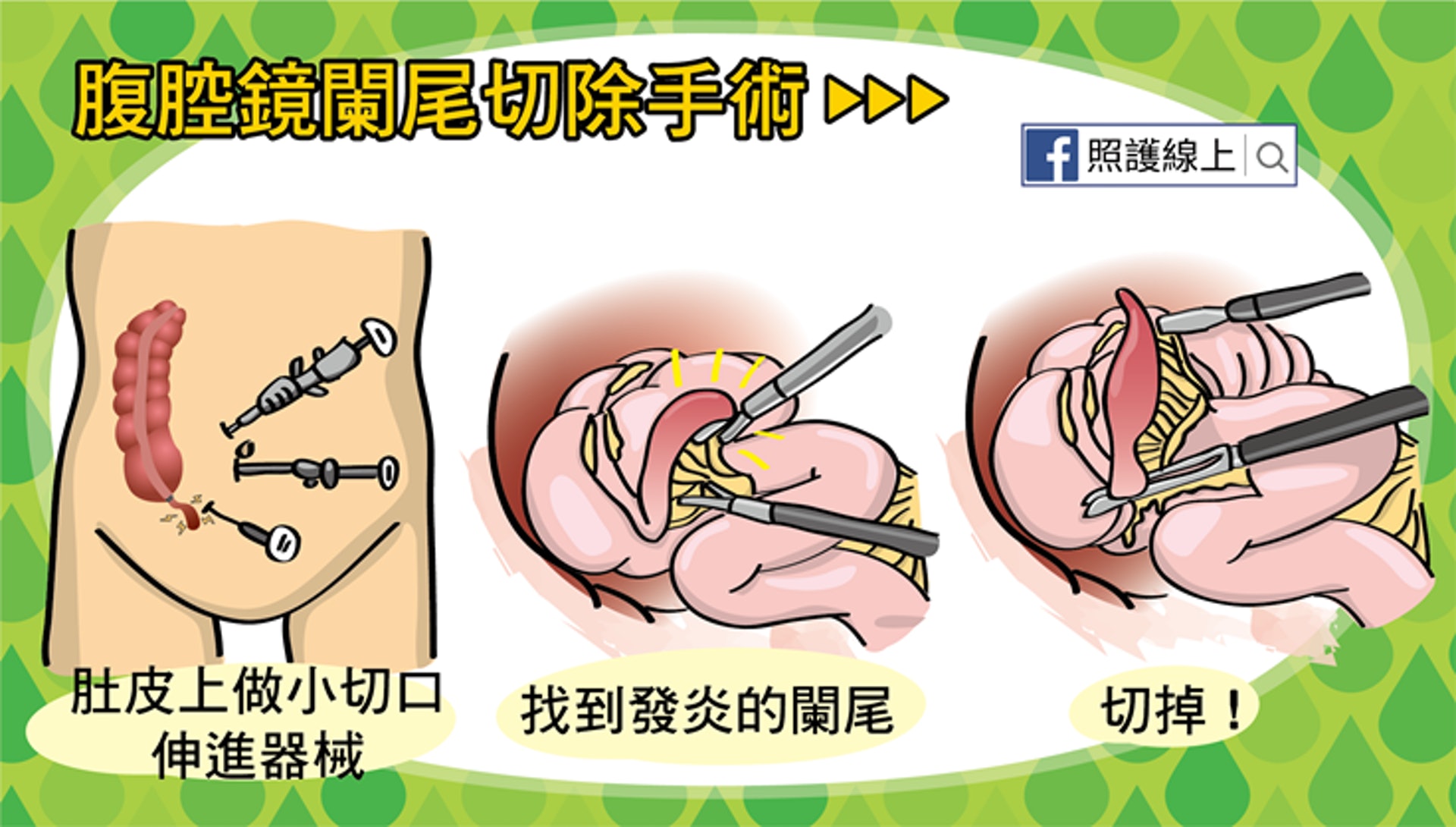 現在腹腔鏡闌尾切除手術也是很常見的（照護線上授權使用）