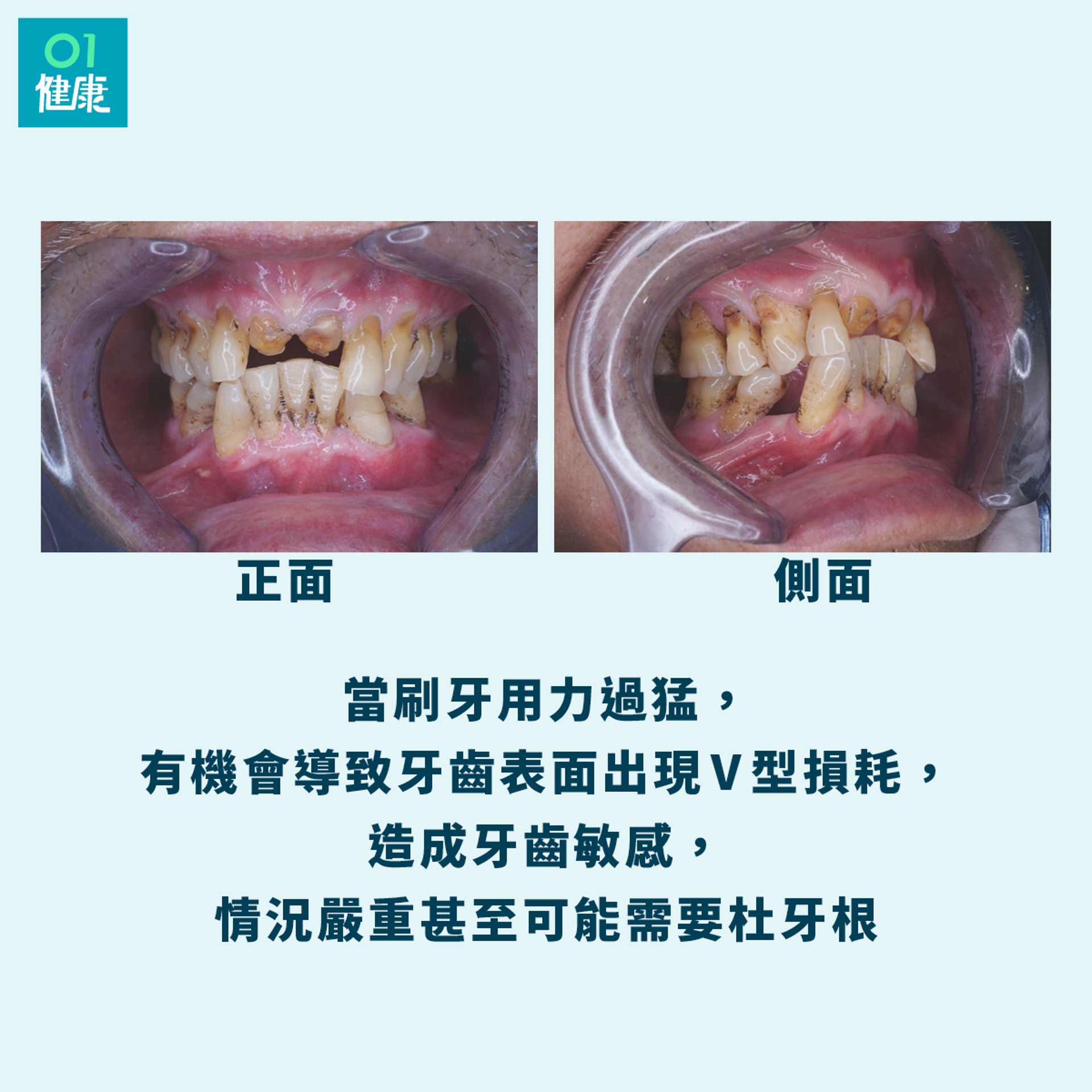 不少人以為刷牙是愈用力愈乾淨,隨時弄巧成拙。(撰稿人授權提供/01製圖) 不少人以為刷牙是愈用力愈乾淨,隨時弄巧成拙。(撰稿人授權提供/01製圖)