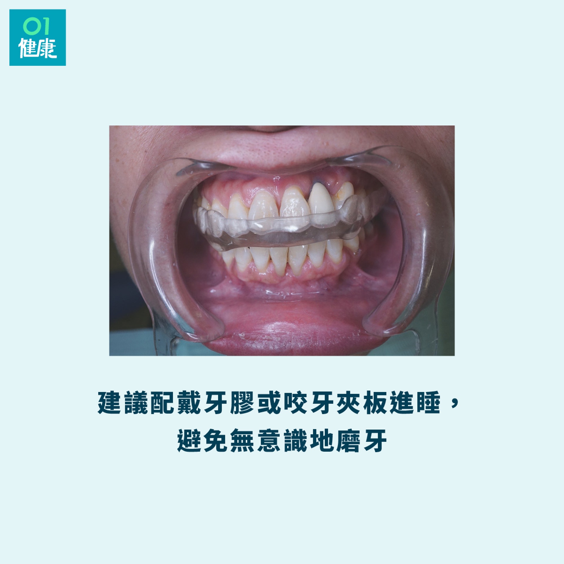 配戴牙或牙夾板套入睡,可以阻止入睡後磨牙的問題,保護牙齒。(撰稿人授權提供/01製圖) 配戴牙或牙夾板套入睡,可以阻止入睡後磨牙的問題,保護牙齒。(撰稿人授權提供/01製圖)