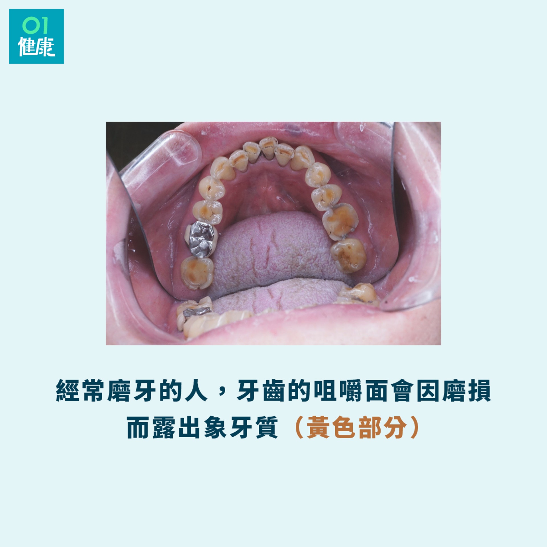 睡覺時無意識的磨牙動作,可能就是導致牙齒敏感的原因。(撰稿人授權提供/01製圖) 睡覺時無意識的磨牙動作,可能就是導致牙齒敏感的原因。(撰稿人授權提供/01製圖)
