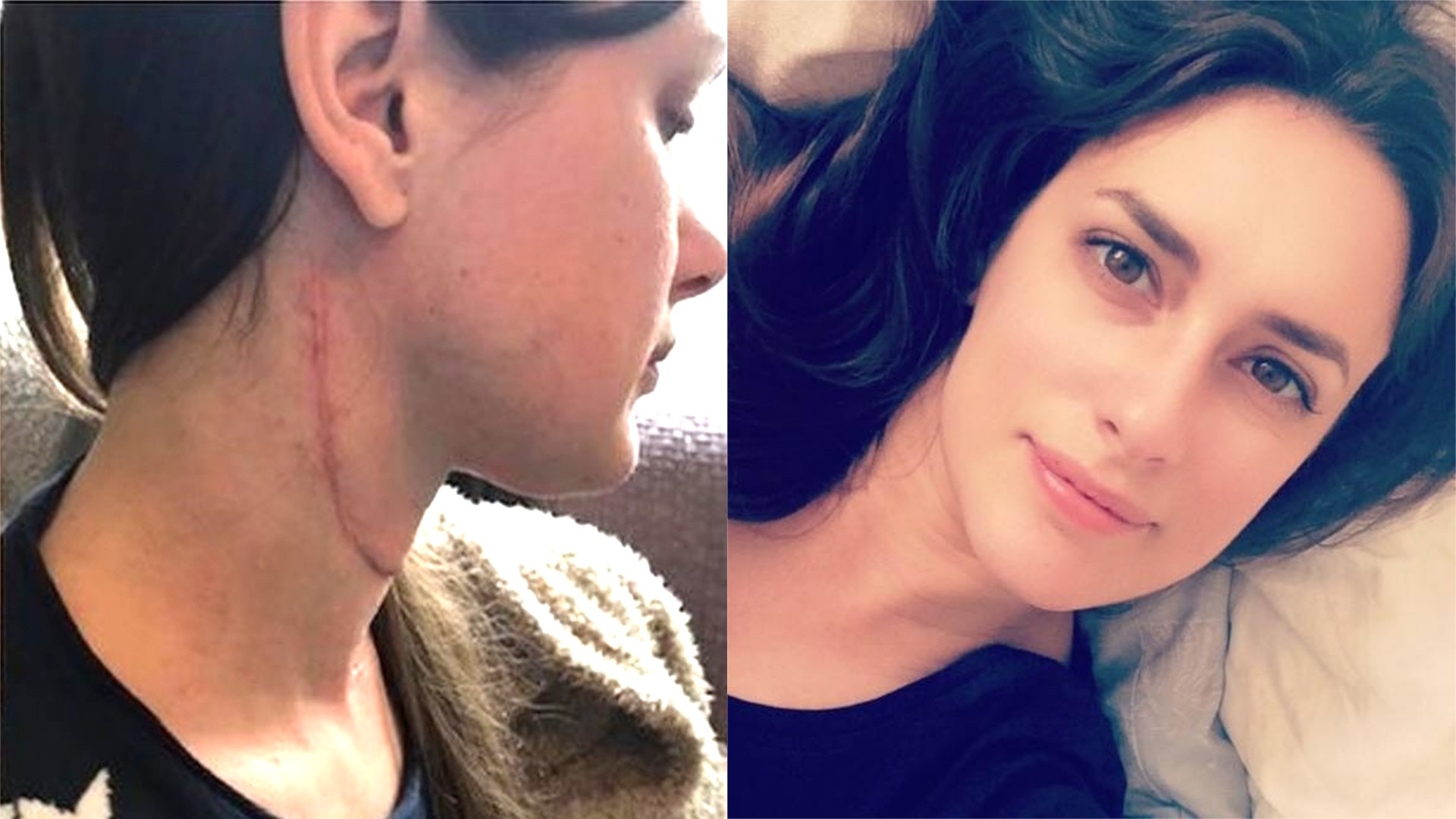 舌頭生瘡8年婚前才知是舌癌需切除幸經醫治用手臂肉重建新舌