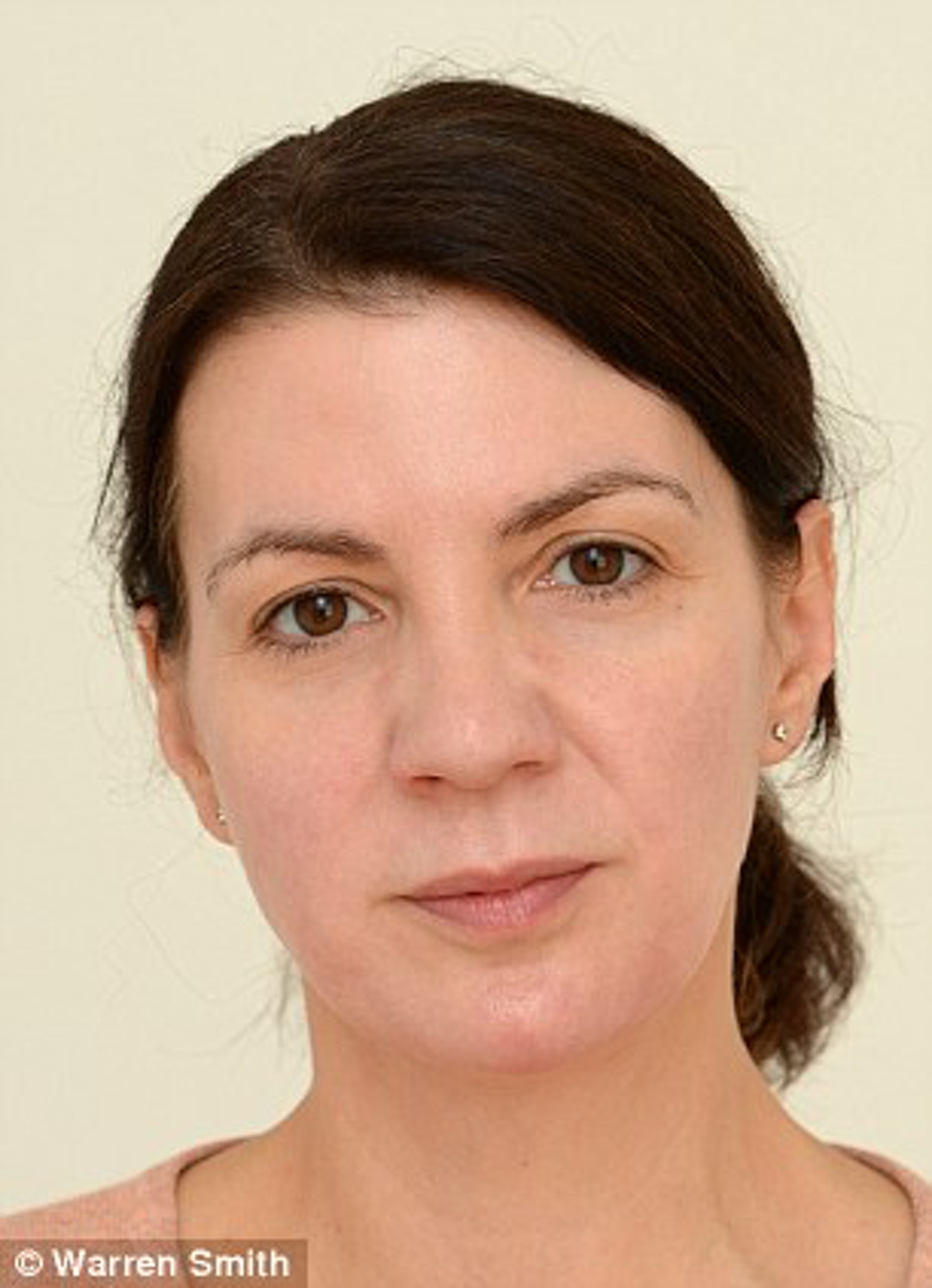 Sarah Smith實驗第四週的皮膚狀況。(Warren Smith@Daily mail)