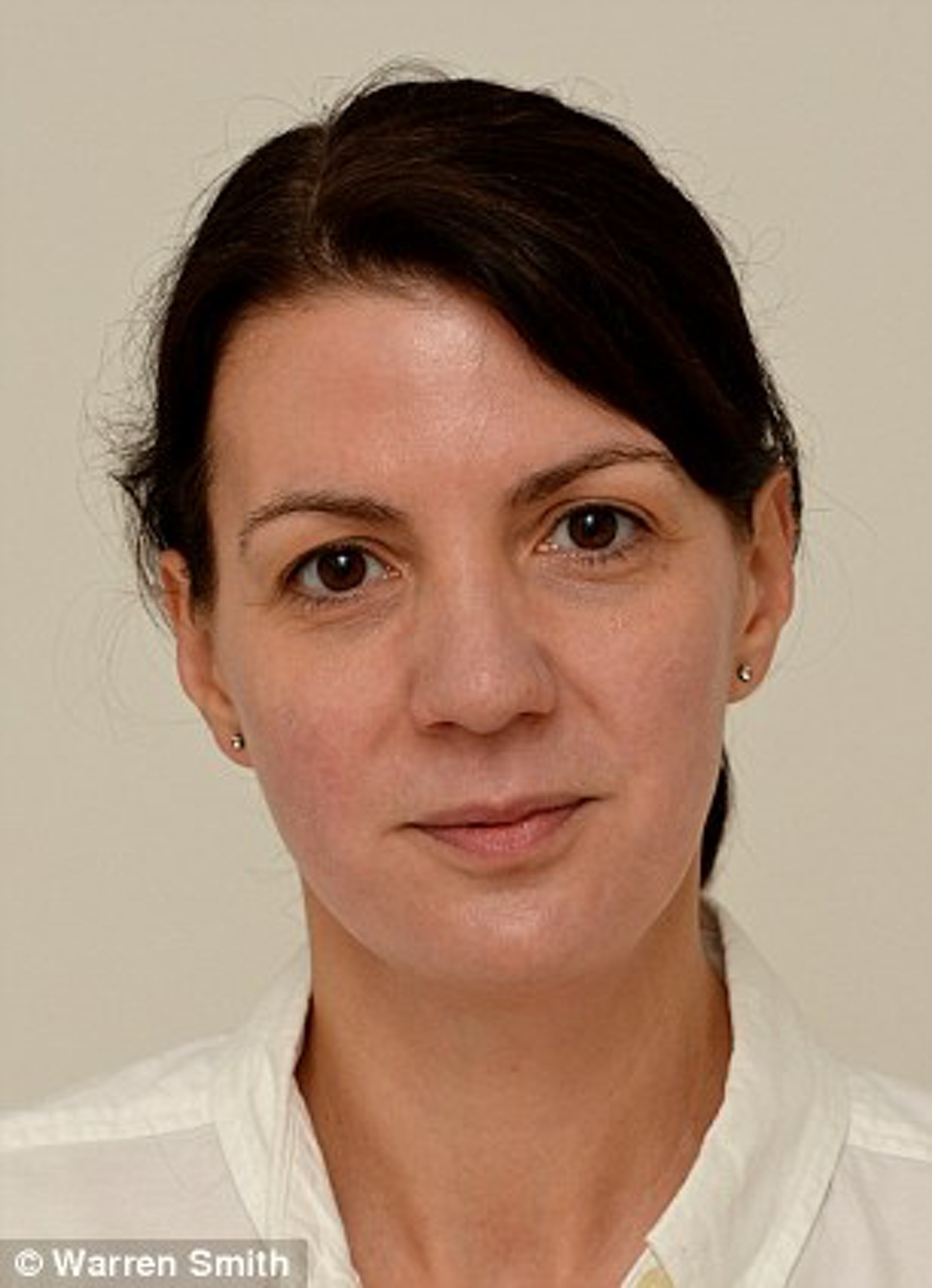 Sarah Smith實驗第三週的皮膚狀況。(Warren Smith@Daily mail)