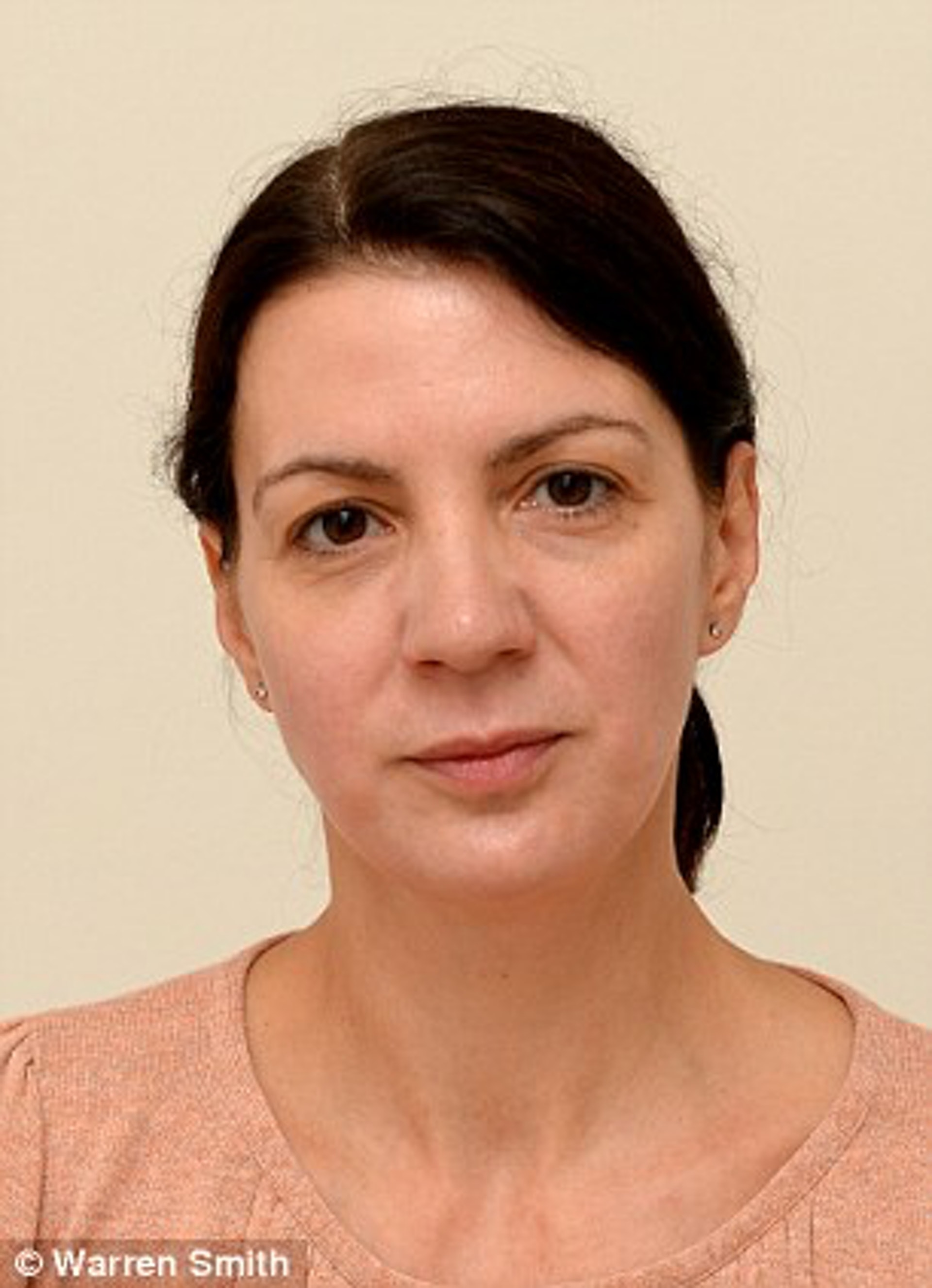 Sarah Smith實驗第二週的皮膚狀況。(Warren Smith@Daily mail)