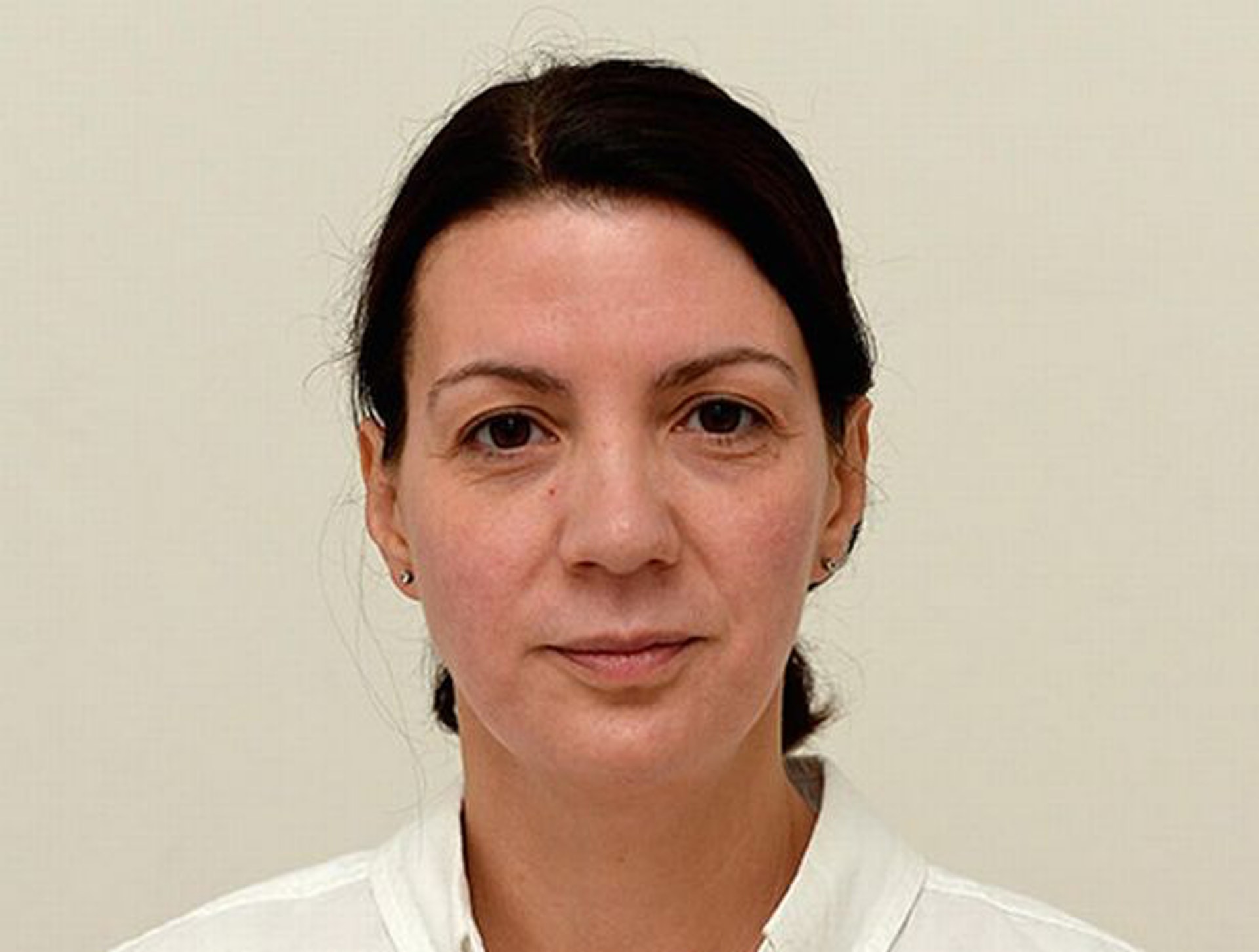 Sarah Smith實驗第一週的皮膚狀況。(Warren Smith@Daily mail)