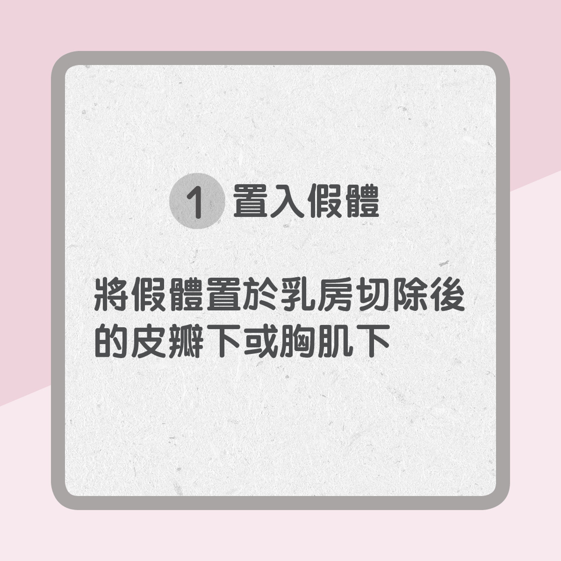 1. 置入假體(01製圖)