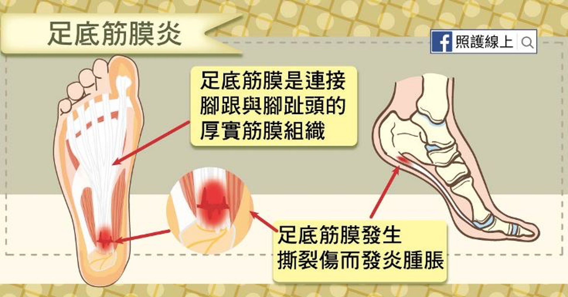 足底筋膜是連接腳跟與腳趾頭的一層厚實筋膜組織，能支撐足弓。（照護線上授權使用）
