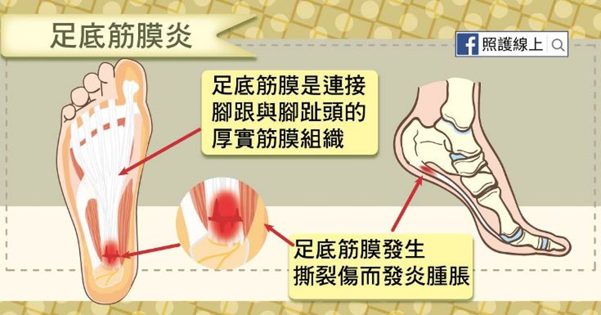 足底筋膜是連接腳跟與腳趾頭的一層厚實筋膜組織,能支撐足弓。(照護線上授權使用) 足底筋膜是連接腳跟與腳趾頭的一層厚實筋膜組織,能支撐足弓。(照護線上授權使用)