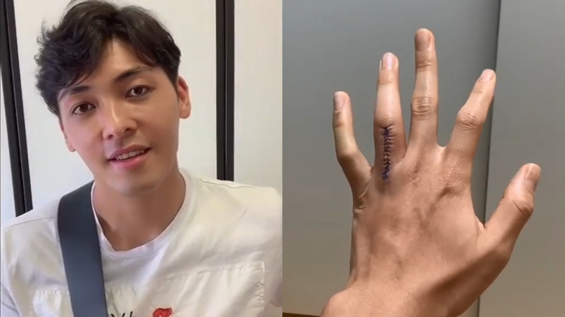 羅孝勇手指骨折斷切除軟骨瘤康復進展良好ig拍片報平安 香港01 即時娛樂