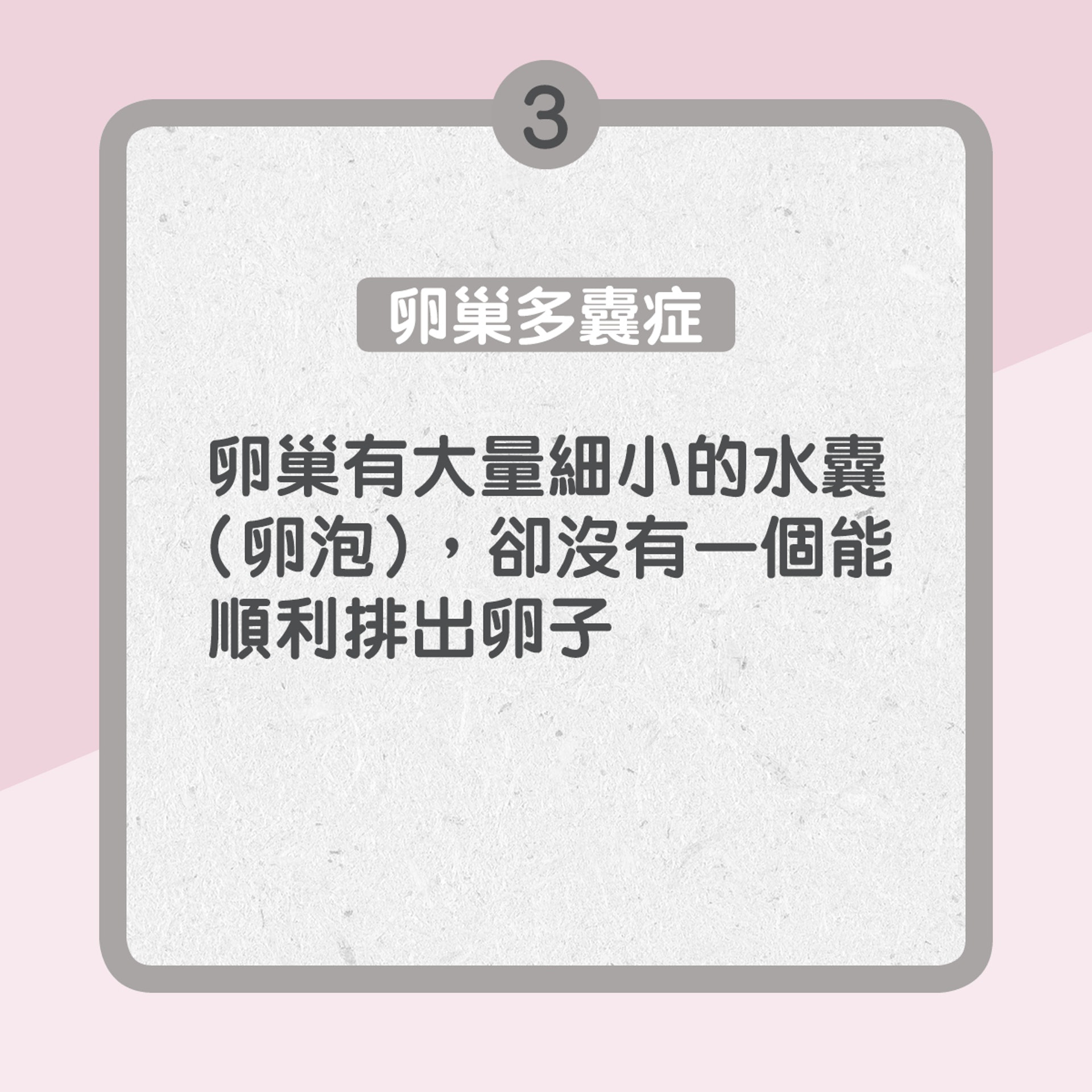 3.　卵巢多囊症：卵巢有大量細小的水囊（卵泡），卻沒有一個能順利排出卵子（01製圖）