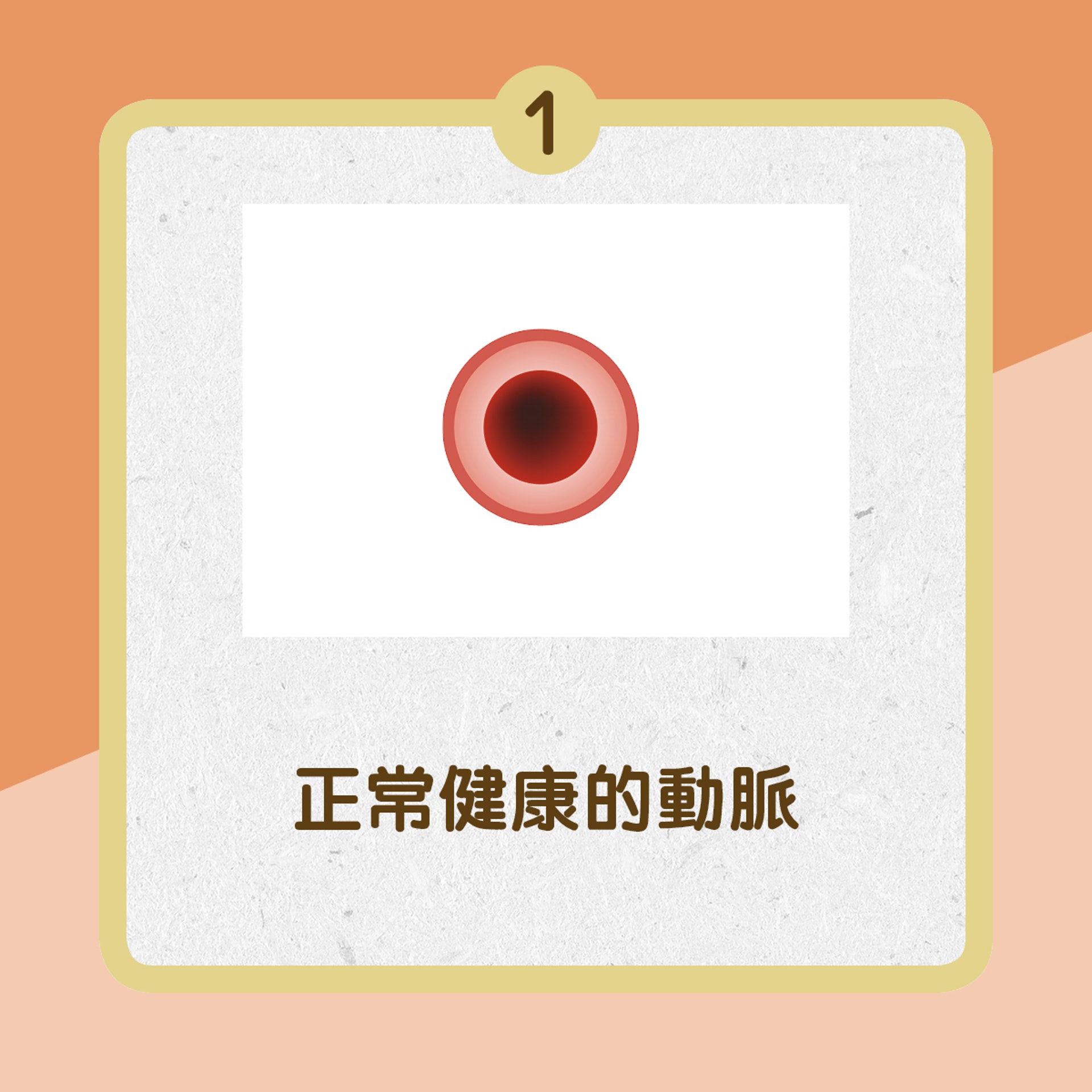 【冠心病成因】1.正常健康的動脈﹙01製圖﹚ 【冠心病成因】1.正常健康的動脈﹙01製圖﹚