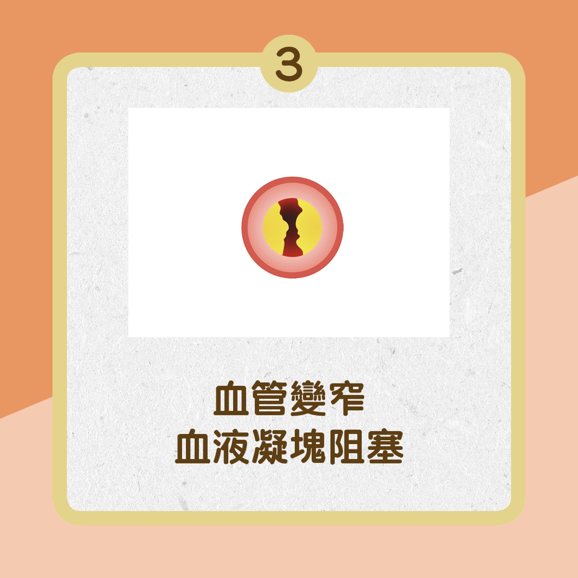 【冠心病成因】3.血管變窄,血液凝塊阻塞﹙01製圖﹚ 【冠心病成因】3.血管變窄,血液凝塊阻塞﹙01製圖﹚