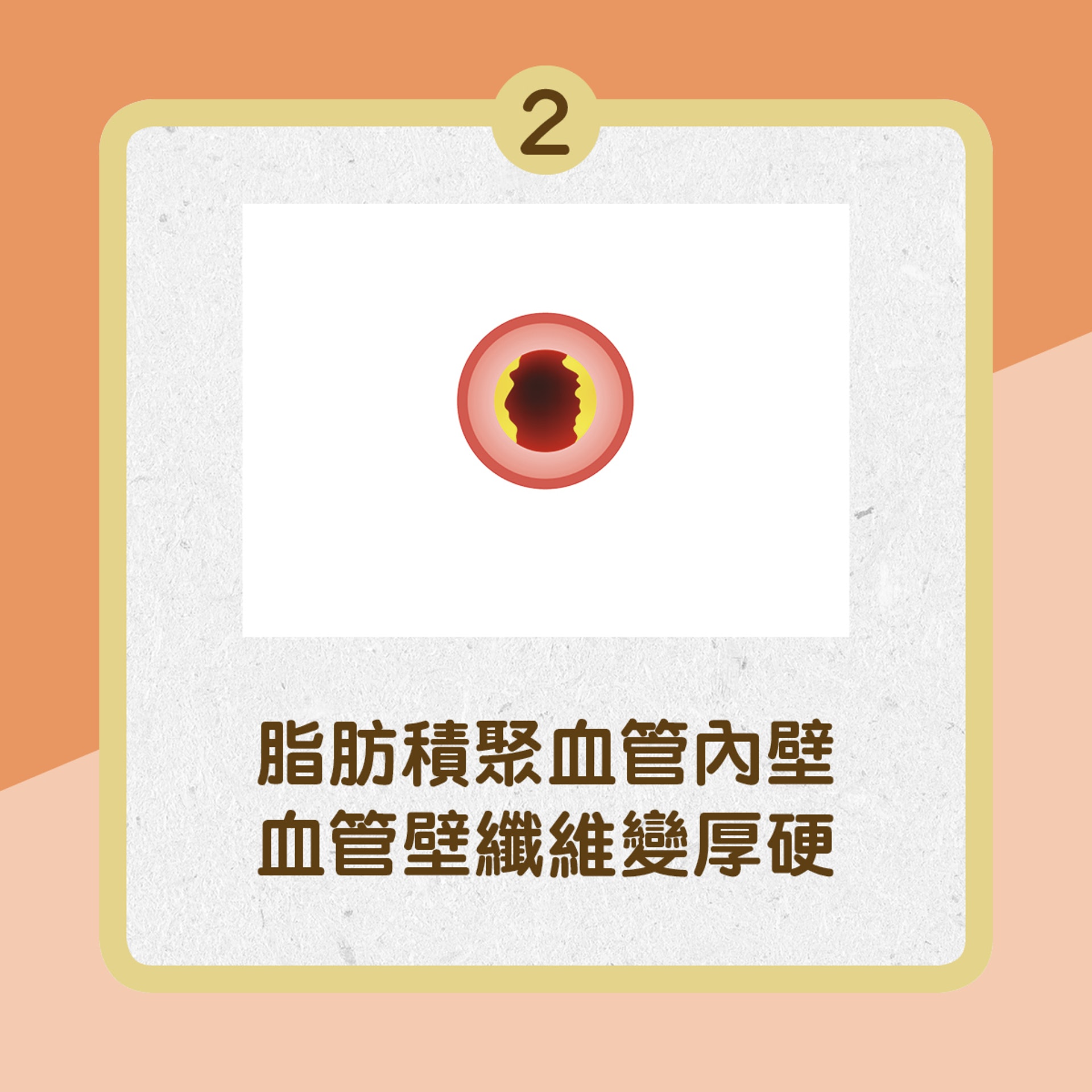 【冠心病成因】2.脂肪積聚血管內壁 血管壁纖維變厚硬﹙01製圖﹚ 【冠心病成因】2.脂肪積聚血管內壁 血管壁纖維變厚硬﹙01製圖﹚