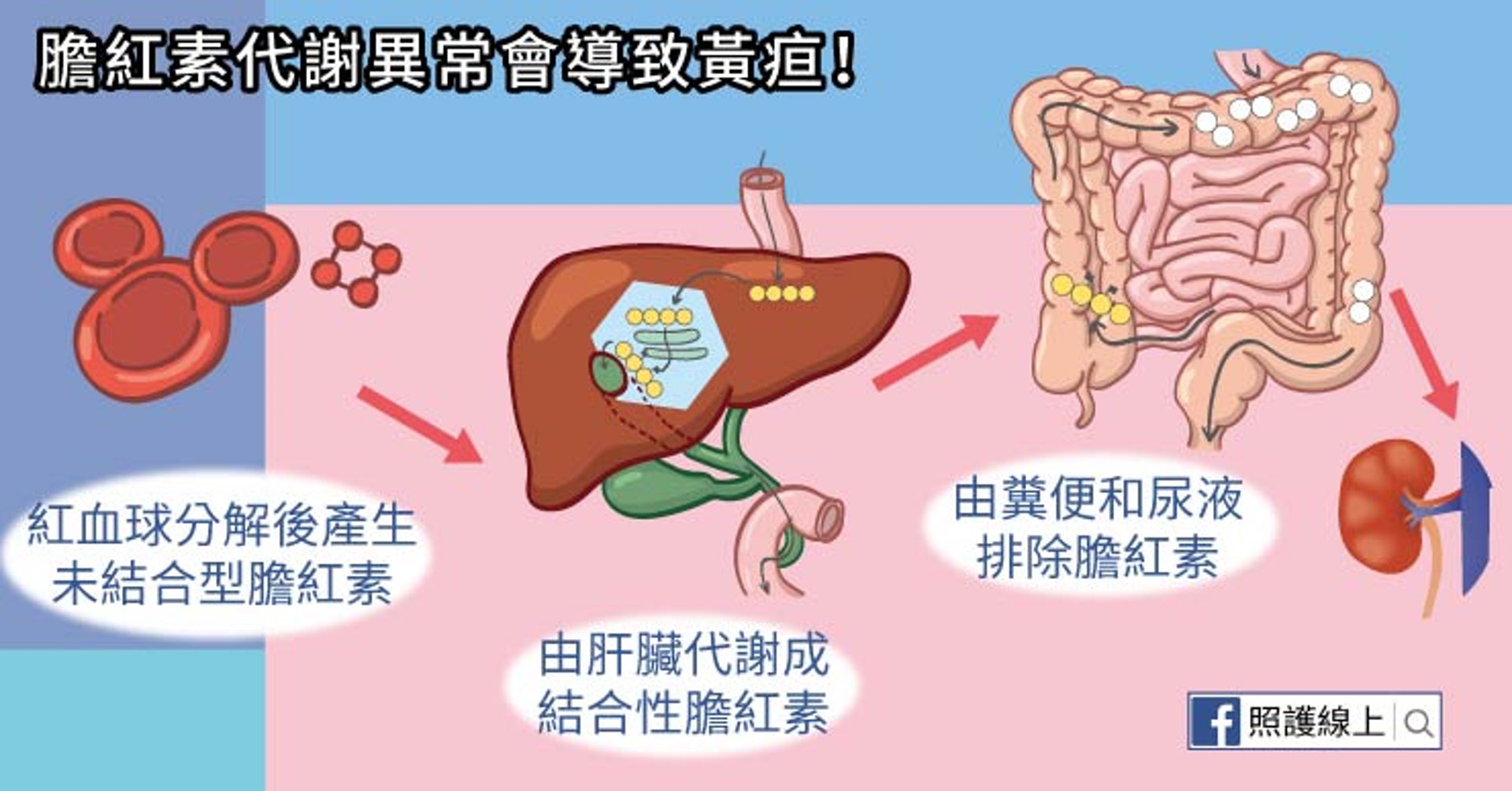 膽紅素代謝異常會導致黃疸!(照護線上授權使用) 膽紅素代謝異常會導致黃疸!(照護線上授權使用)