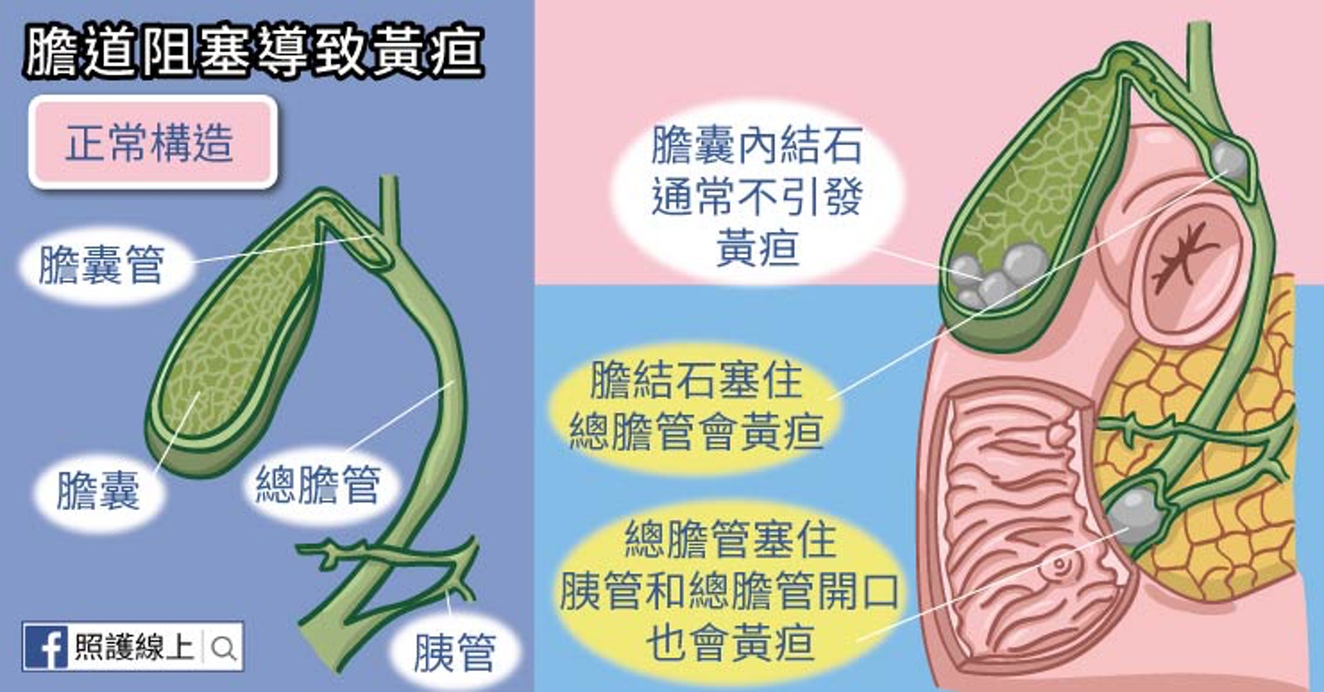 膽道阻塞導致黃疸(照護線上授權使用) 膽道阻塞導致黃疸(照護線上授權使用)