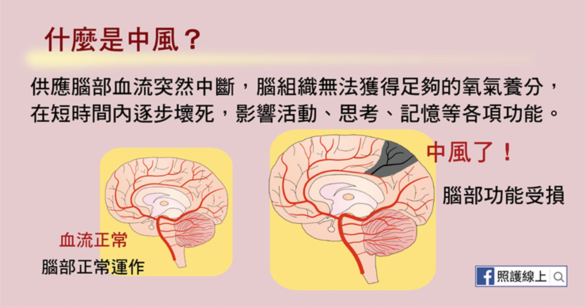 什麼是中風？（照護線上授權使用）