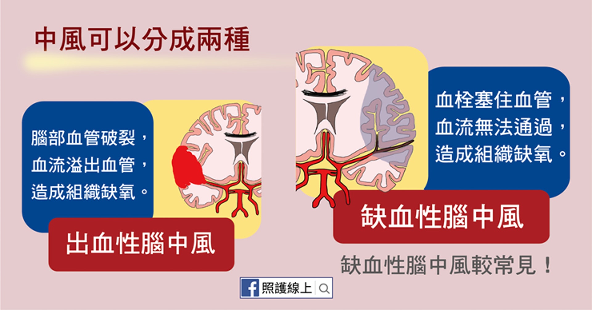 【中風】缺血性腦中風救治黃金三小時 「FAST」口訣判斷中風徵狀|醫師Easy