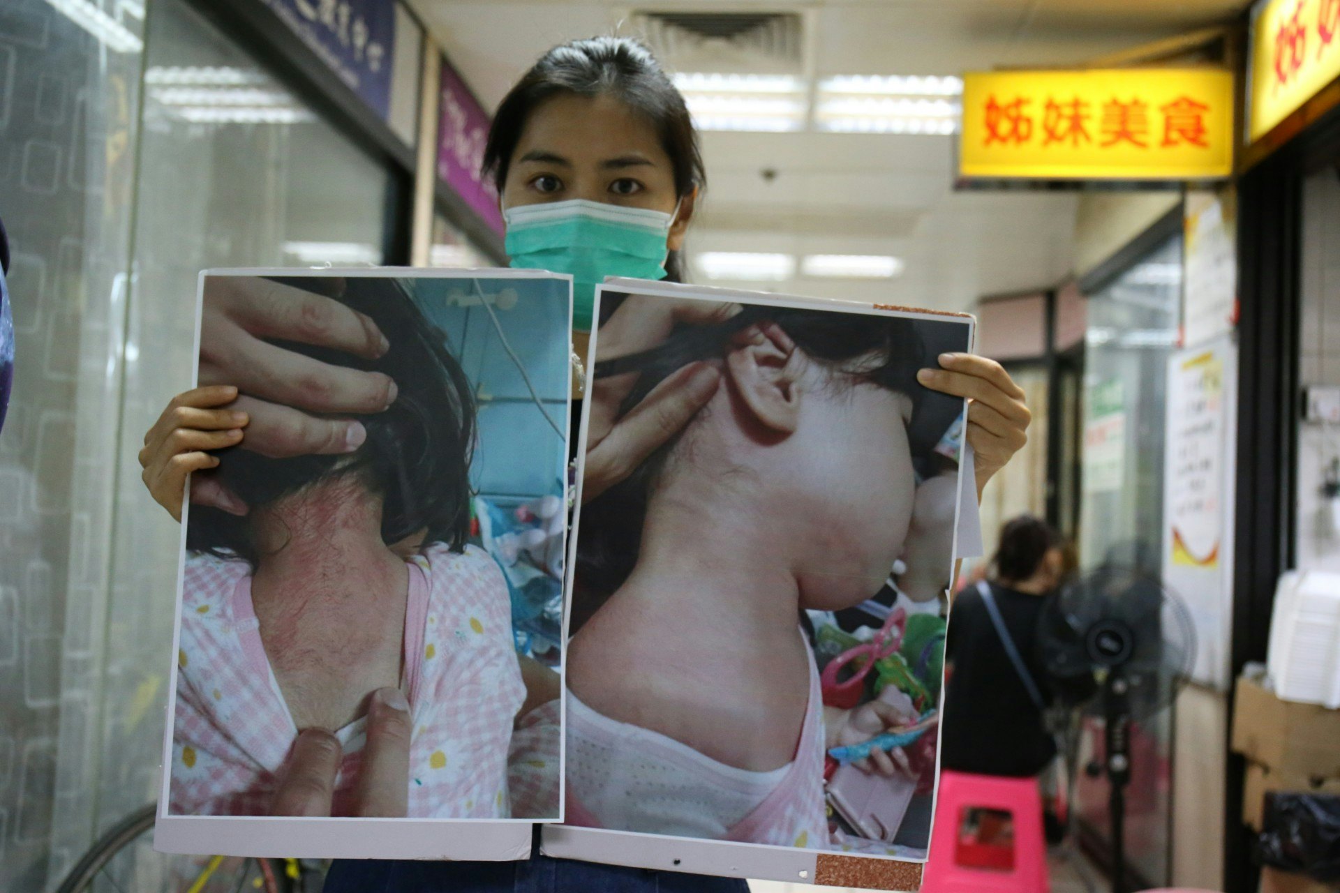 有屯門居民展示女兒接觸不明氣體後,身體多處出現紅疹。(資料圖片/鄧詠中攝) 有屯門居民展示女兒接觸不明氣體後,身體多處出現紅疹。(資料圖片/鄧詠中攝)