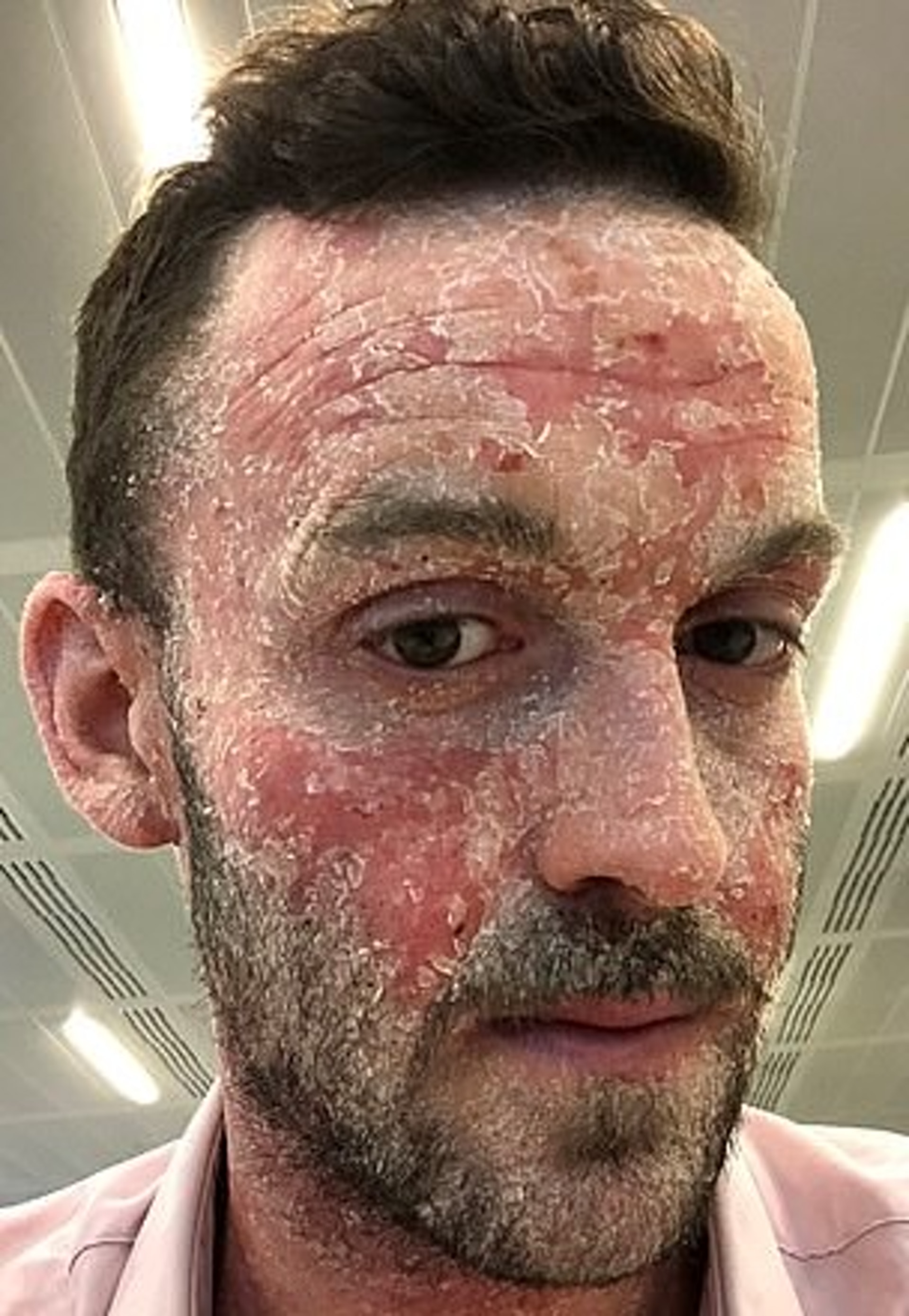 羅維過去十多年一直受濕疹困擾。(Jonathan Rowe@Instagram) 羅維過去十多年一直受濕疹困擾。(Jonathan Rowe@Instagram)