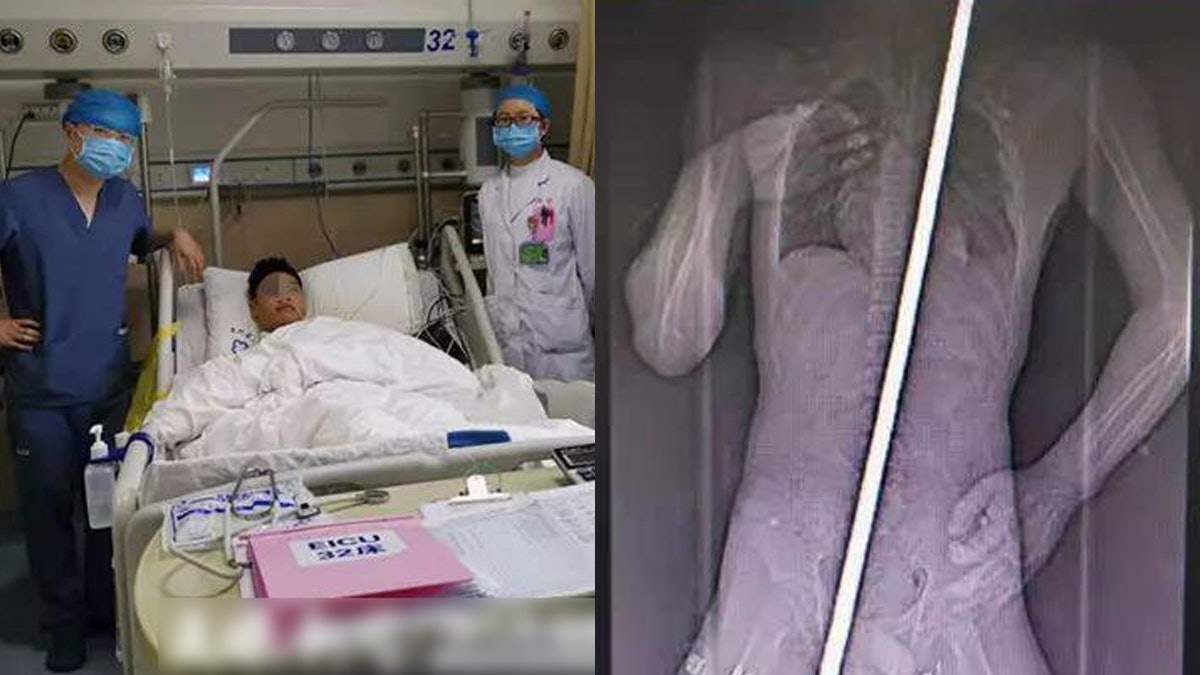 13歲男童墮樓遭鋼筋貫穿全身 大難不死全因剛好心臟收縮! 13歲男童墮樓遭鋼筋貫穿全身 大難不死全因剛好心臟收縮!
