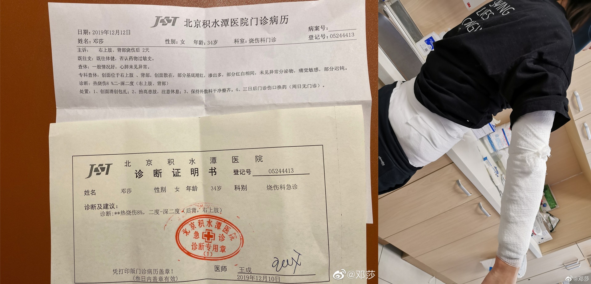 鄧莎曬出病例與包扎的傷口。(微博@鄧莎) 鄧莎曬出病例與包扎的傷口。(微博@鄧莎)