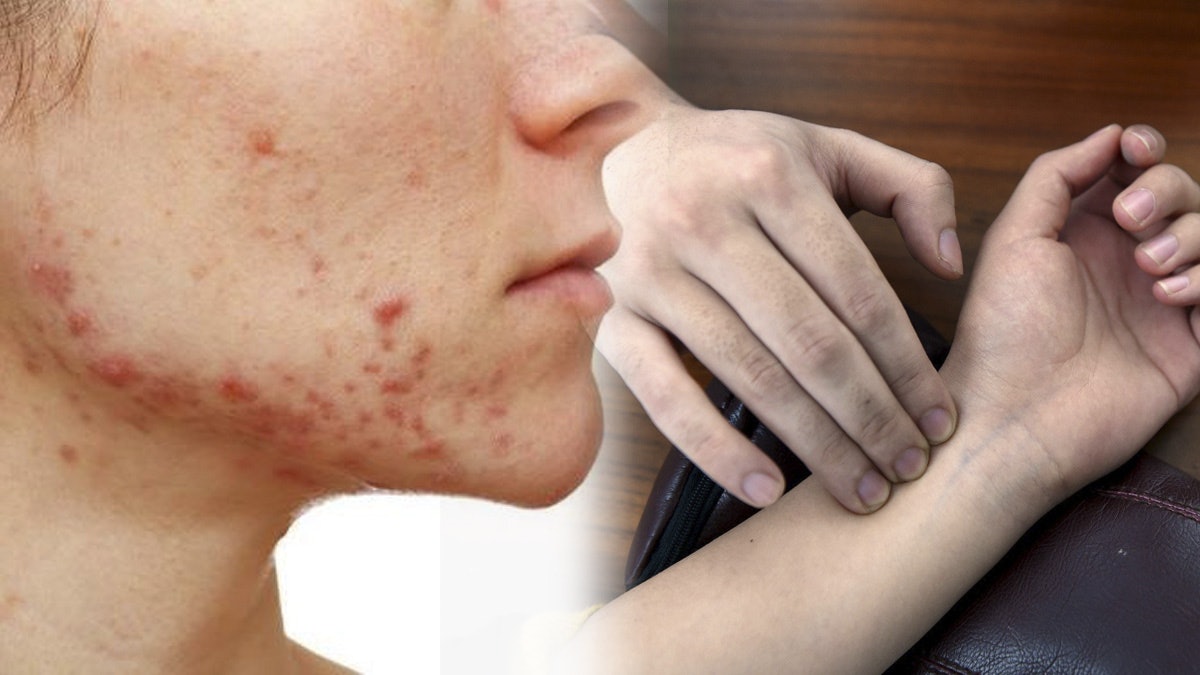 【健康百科】治療暗瘡與調經有關? 中醫舉實例解釋如何趕走膿瘡