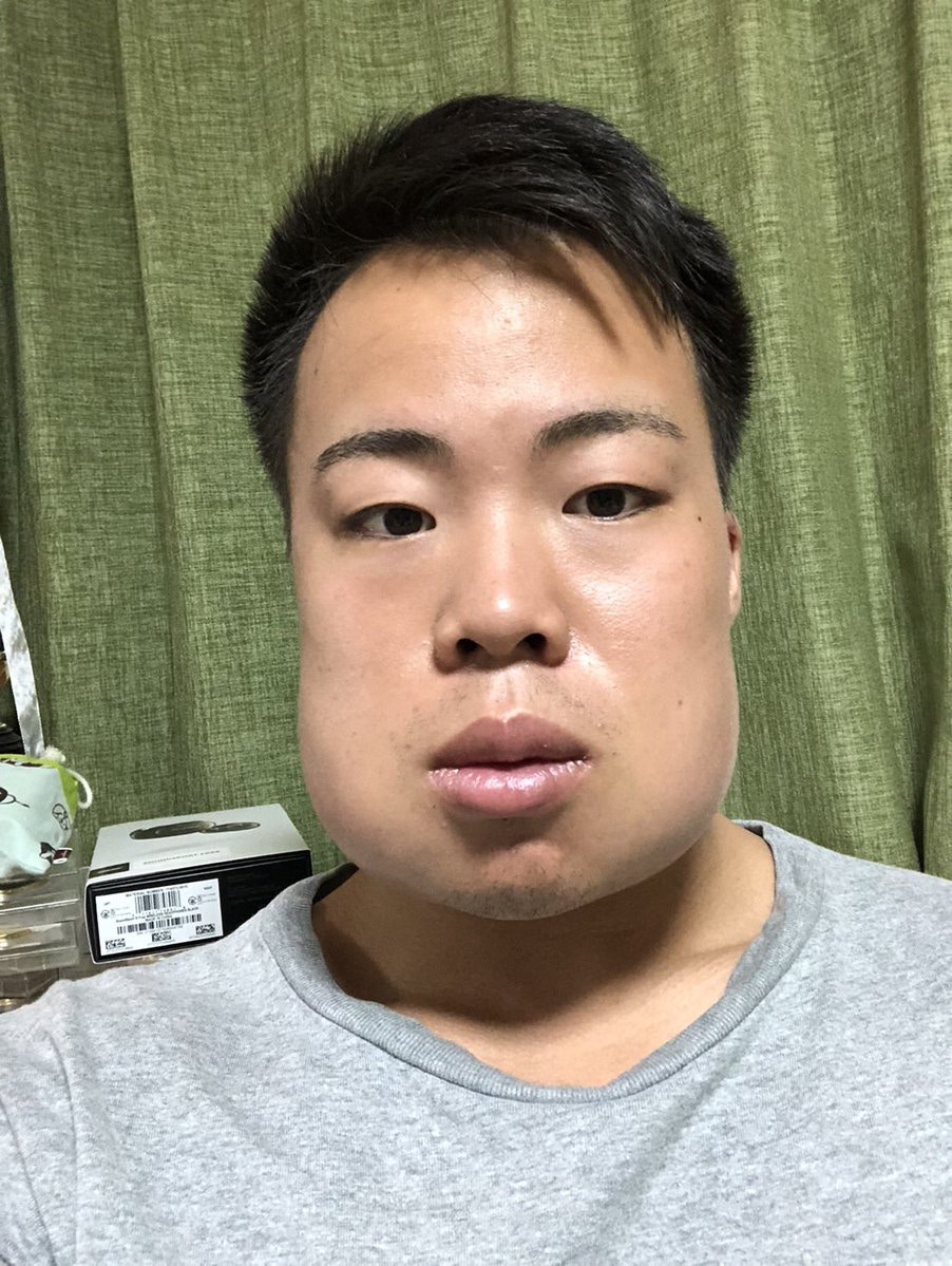 日本網民選擇一口氣拔掉4顆，結果下巴腫脹如豬頭一樣。（Twitter「zumi5299」圖片）