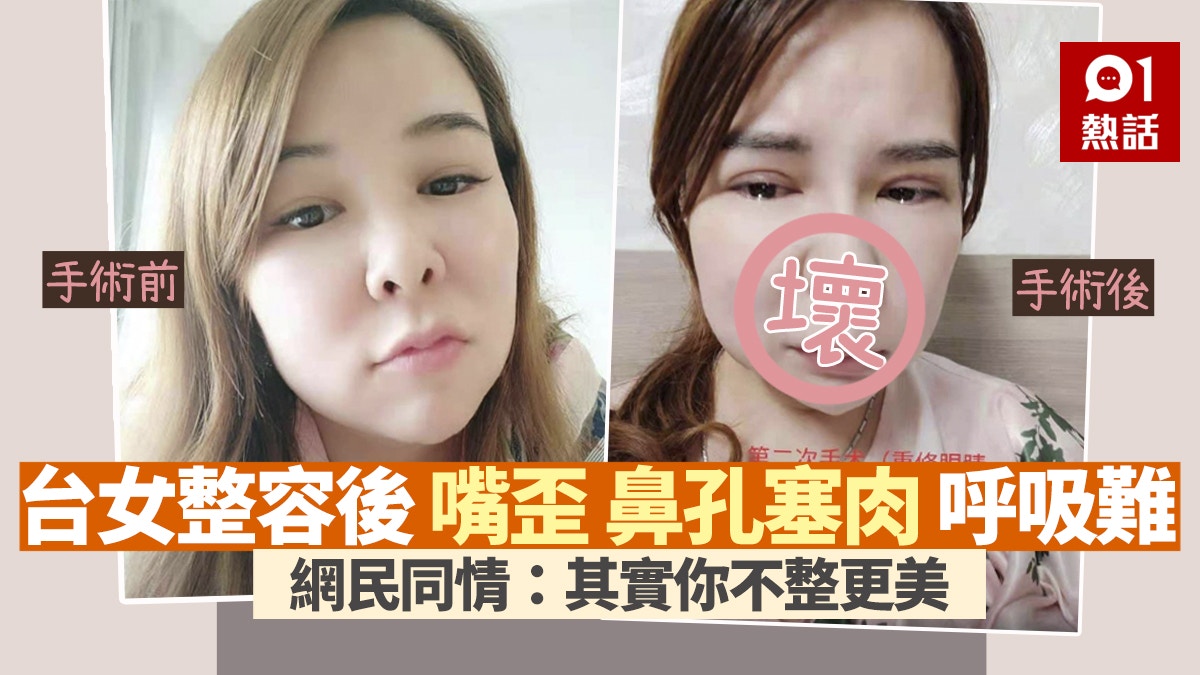 整容後嘴歪鼻歪呼吸困難台女崩潰 診所說那是技術最好的醫師 香港01 熱爆話題