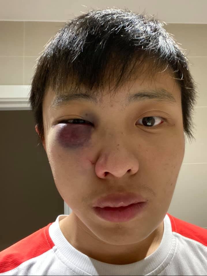 Jonathan Mok的左眼被打到腫了一塊，亦有流鼻血，連下巴都有血迹。（Jonathan Mok fb圖片）