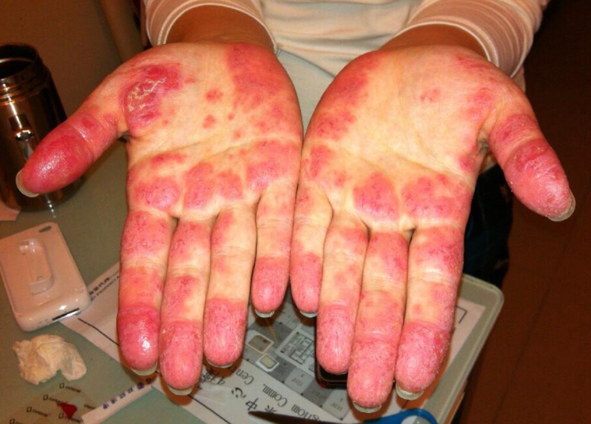 李燕嫻指發病時，手掌均出現紅腫脫皮，並大範圍長出紅斑。（受訪者提供）
