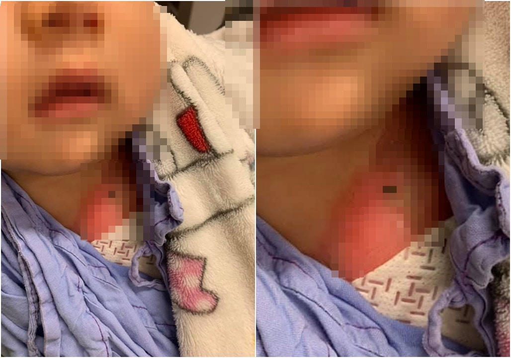 二級燒傷嬰留醫兩日出院　母自責未阻意外發生　不追究女傭