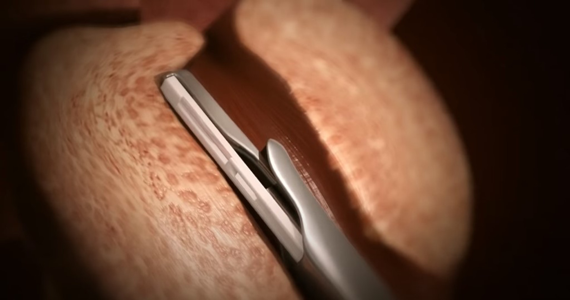 儀器經尿道進入前列腺。(UroLift YouTube影片截圖)