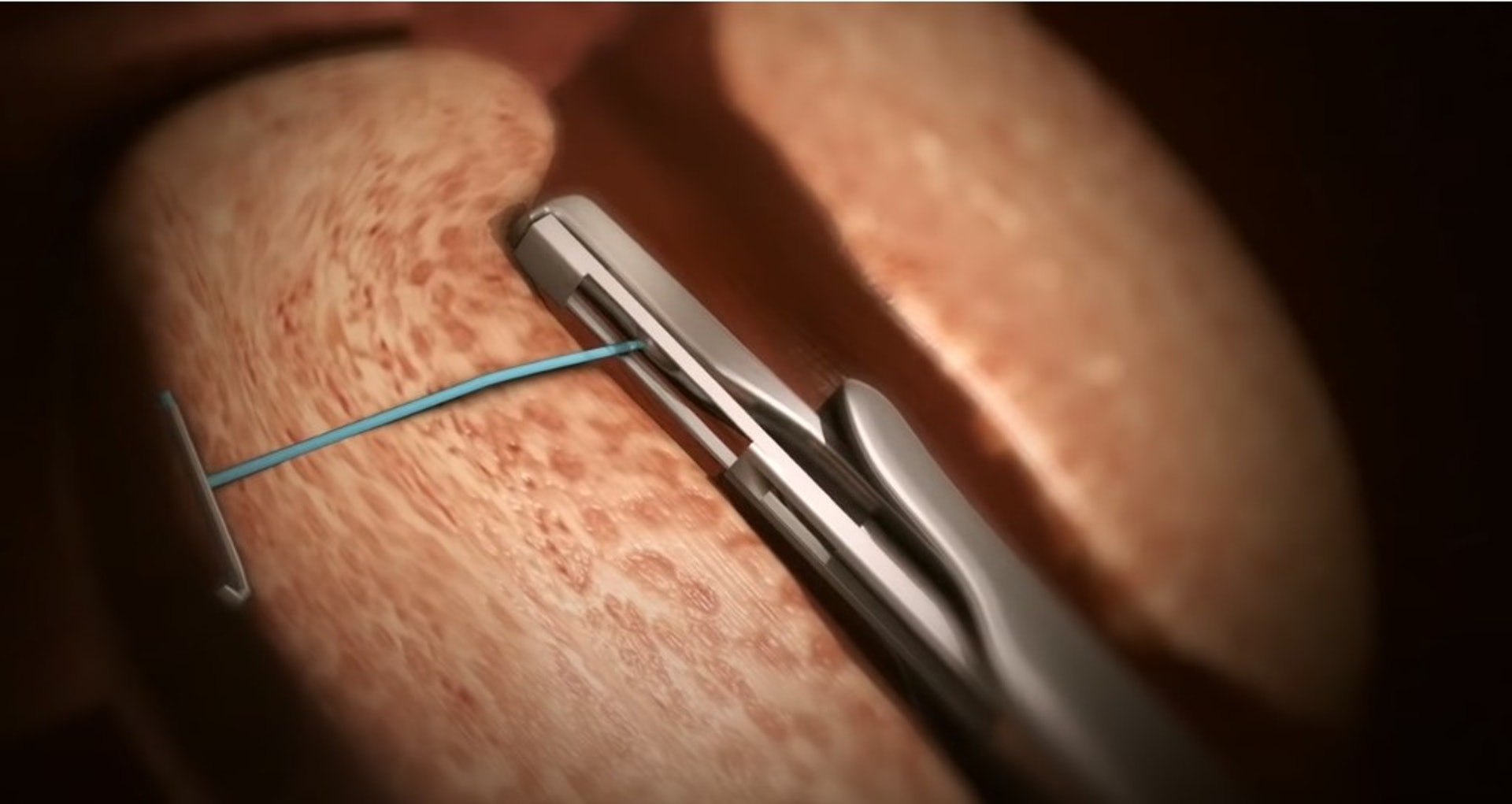 植入植體拉高肥大組織。(UroLift YouTube影片截圖)