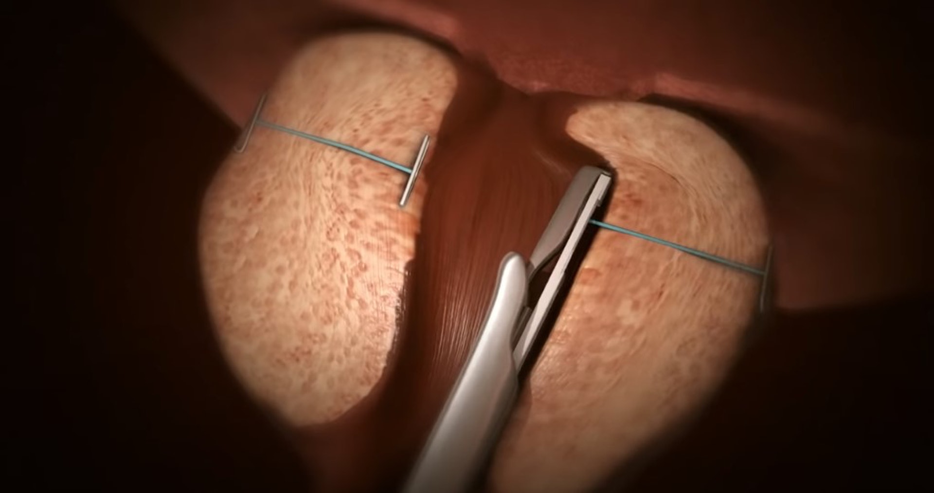 植入植體拉高肥大組織。(UroLift YouTube影片截圖)