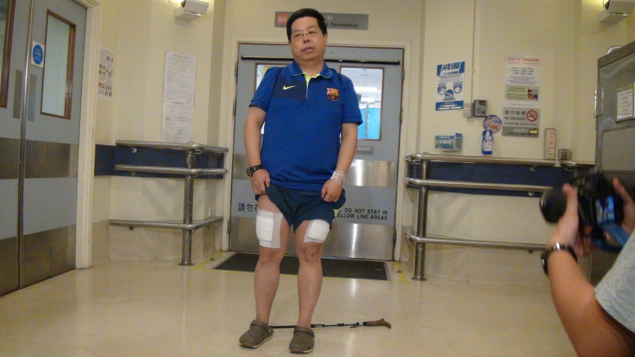 林子健到醫院拔去大腿的釘書釘，留院一晚後，於周六（12日 ）出院。（資料圖片）