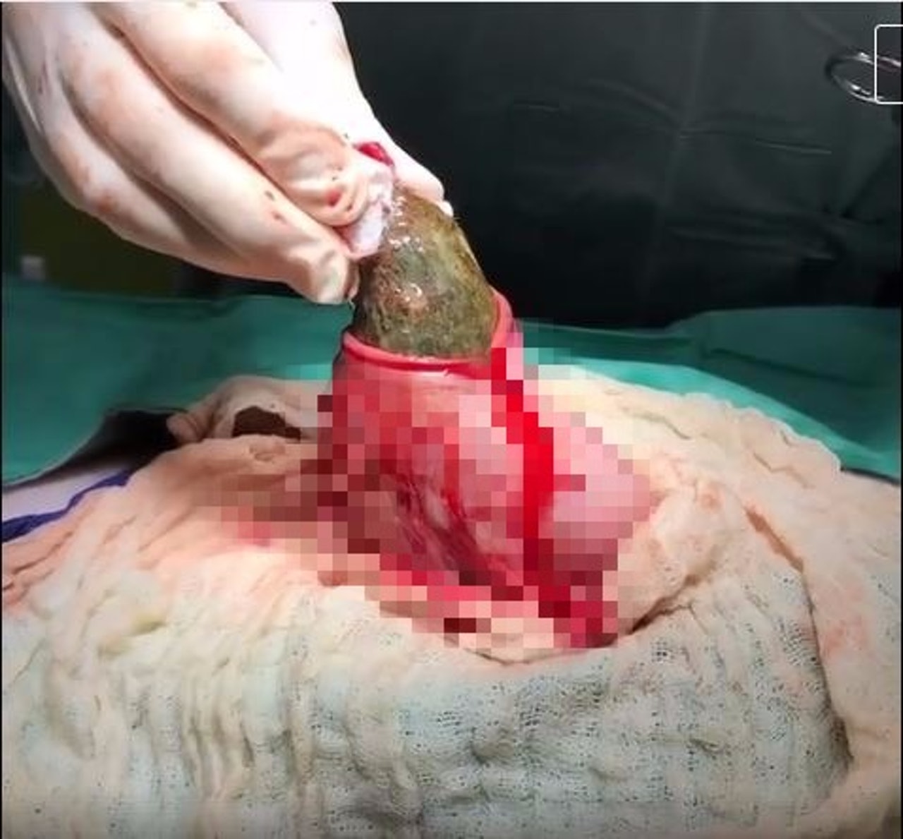 獸醫在貓咪胃內取出「巨石」。(Harbour City Animal Hospital) 獸醫在貓咪胃內取出「巨石」。(Harbour City Animal Hospital)