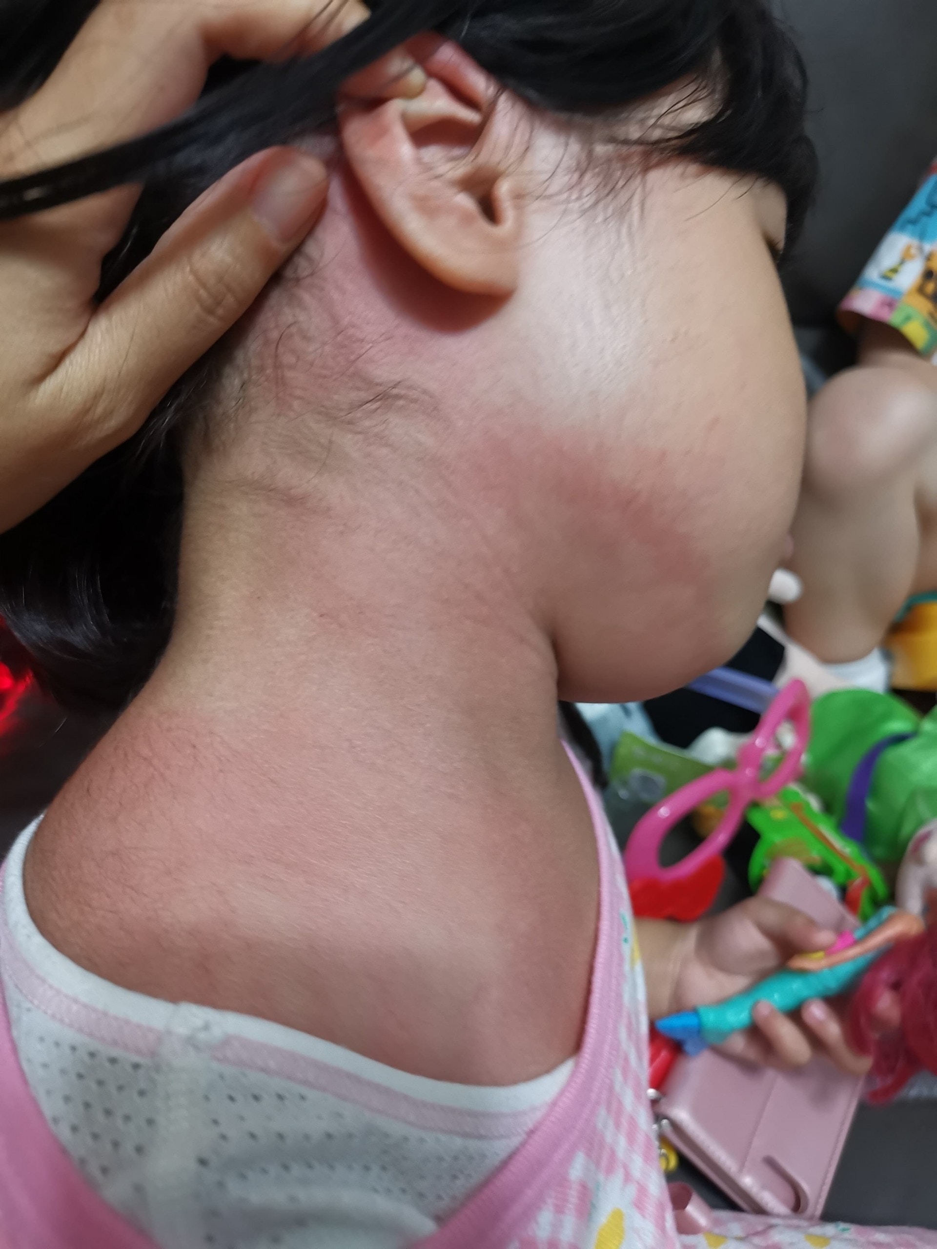 A小姐女兒背部出現紅疹。(受訪者提供) A小姐女兒背部出現紅疹。(受訪者提供)