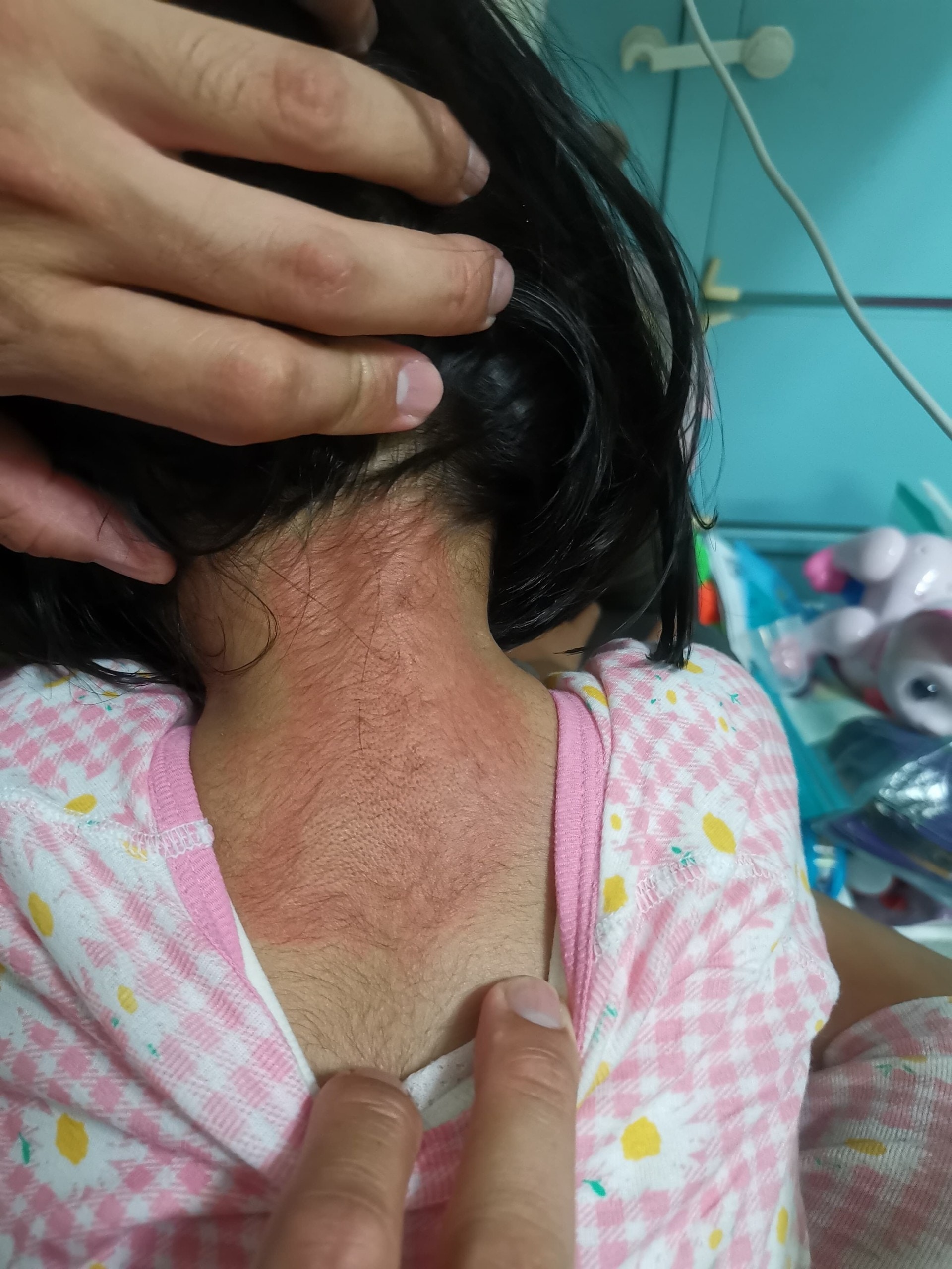 由於女兒從來沒有濕疹等皮膚問題,A小姐相信與昨午侵襲屯門的刺激性氣體有關。(受訪者提供) 由於女兒從來沒有濕疹等皮膚問題,A小姐相信與昨午侵襲屯門的刺激性氣體有關。(受訪者提供)